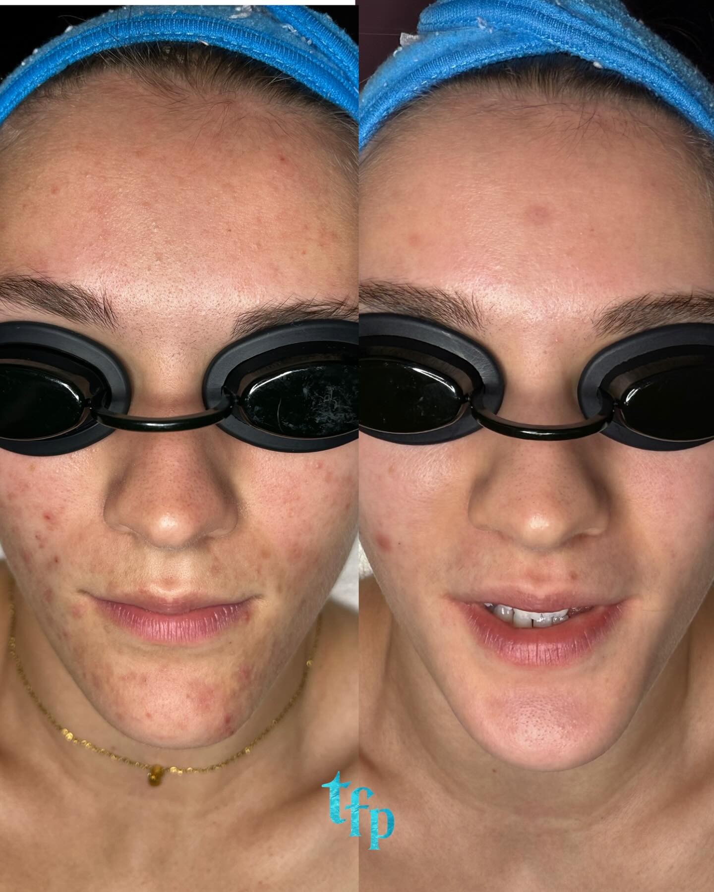 Acne bootcamp slay 🌊🥥 4 months acne transformation!
I’m taking new bootcamp clients! Book the new client acne facial to start or read more about bootcamp under my Instagram highlight on under “acne bootcamp” on Thefaceplacemi.com 🩵