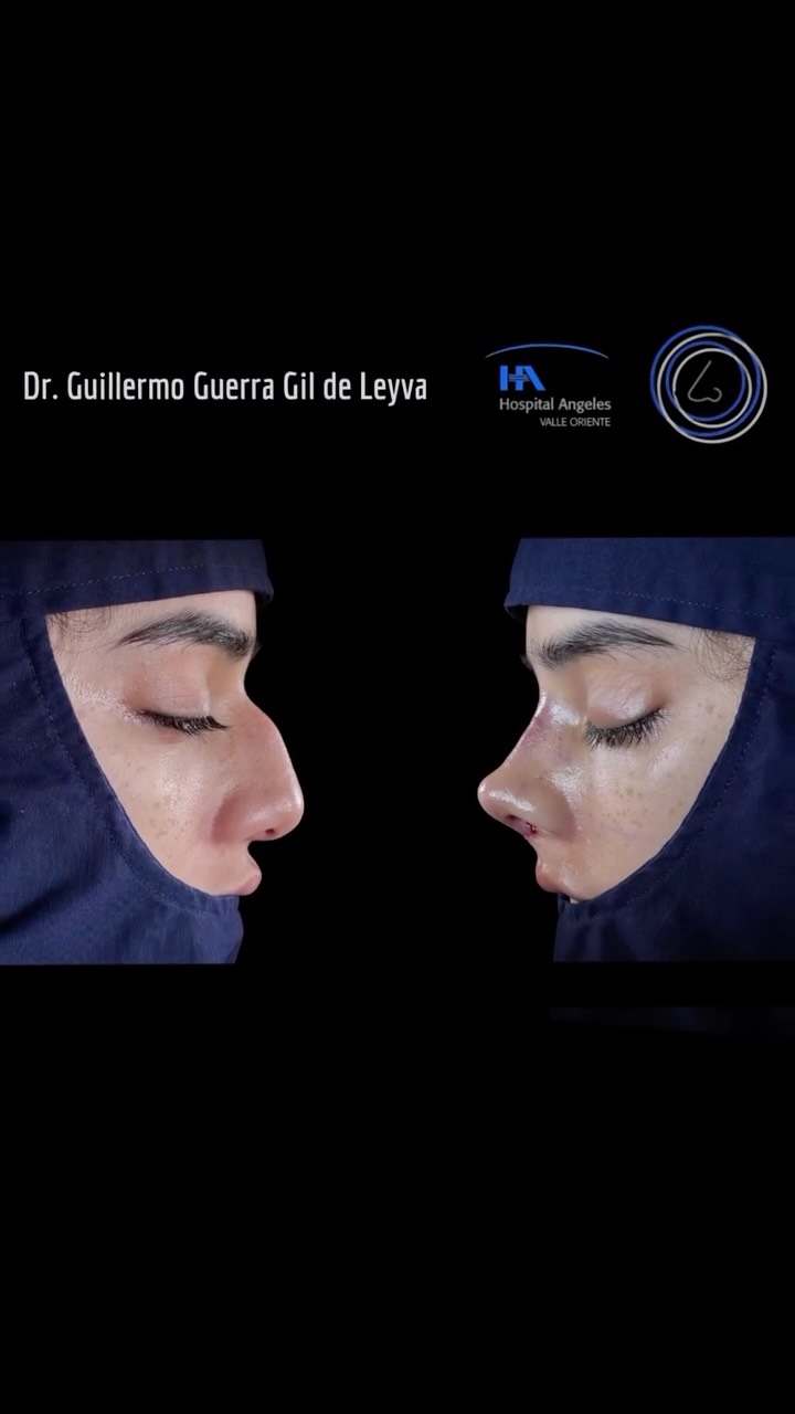 🔹 Con nuestra Rinoplastia personalizada, nos enfocamos en tus deseos y la estructura facial única. El resultado: una nariz que complementa tu belleza natural,. ¡Agenda tu consulta!.
🔹Resultado inmediato Rinoplastia Estética y Funcional.
🔹 Gracias a mi excelente paciente por su confianza y permitir compartir su resultado.
🔹”Made by hand. Crafted with passion”
🧑⚕️ Dr. Guillermo Guerra Gil de Leyva
🏥 Hospital Ángeles Valle Oriente
📱 81-1252-0132
🎓Universidad de Monterrey
👃 Rinoplastia Estética y Funcional
🚫 No taponamiento
Cédula Profesional: 3070499
Cédula Especialista: 4503273
No. Certificación CONACEM: GUG-1748/04
Aviso de Publicidad COFEPRIS: 2419032002A00111
❕Paciente autoriza difusión de imágenes con fines académicos e informativos.
❕Los resultados finales se pudieran observar hasta un año de la cirugía y dependerá tanto del compromiso del cirujano como del paciente, así como del tipo de cirugía, tipo de piel, cuidados post-operatorios, etc.
#CirugíaFacial #RinoplastiaEspecializada
#rinoplastia #rhinoplasty #septoplastia septoplasty rinoseptumplastia rhinoseptoplasty nosejob nose nosesurgery tabiquenasal otorrinolaringologia entsurgery cirugianasal cirugiatabique cirugiaesteticanasal
belleza confianza autoestima
cosmeticsurgery
otorrinolaringologiamonterrey otorrinomonterrey beforeandafter antesydespues
estructuredrhinoplasty
rinoplastiaestructurada
rinoplastiaultrasonica
ultrasonicrhinoplasty