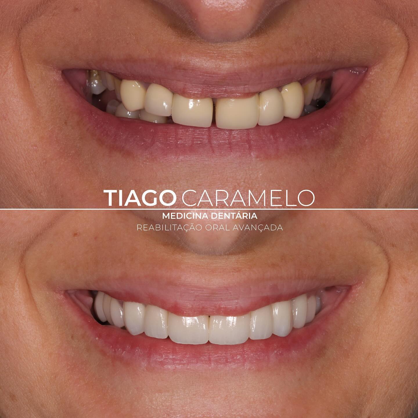 Neste caso, a paciente tinha indicação clara para realização de cirurgia maxilo-facial devido à discrepância esquelética existente que se traduzia numa oclusão pouco funcional. Ainda assim, a paciente recusou submeter-se a tal cirurgia e optei por, através de coroas e facetas cerâmicas, devolver uma estética e função equilibradas.
—————————————————————————————
In this case, the patient had a clear indication for maxillofacial surgery due to the existing skeletal discrepancy, which resulted in a poorly functional occlusion. Even so, the patient refused to undergo such surgery, and I decided to restore a balanced aesthetics and function through ceramic crowns and veneers.
#veneers #crowns #oralrehabilitaion #toothprep #adhesivedentistrsy