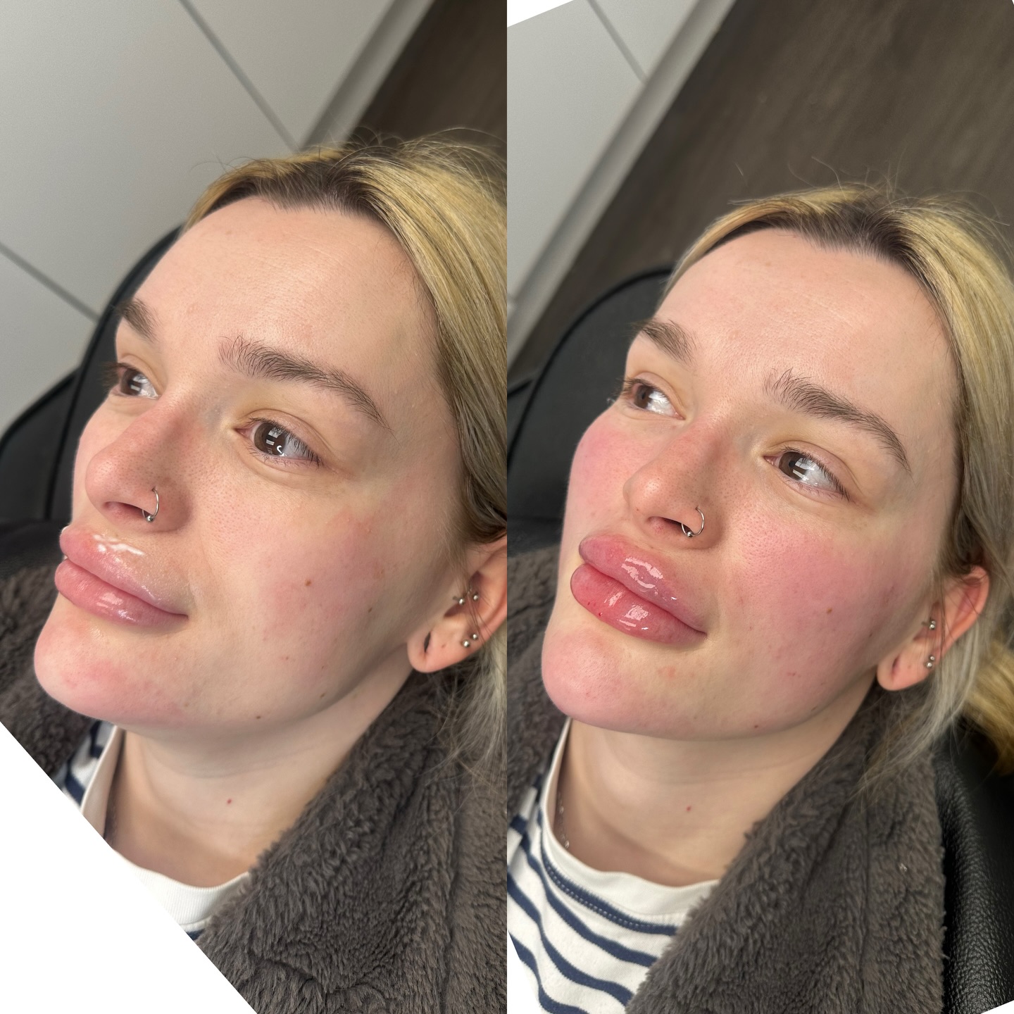 Cheek & Chin Combo is definitely an underrated treatment! Giving that contour and V definition 📐😍