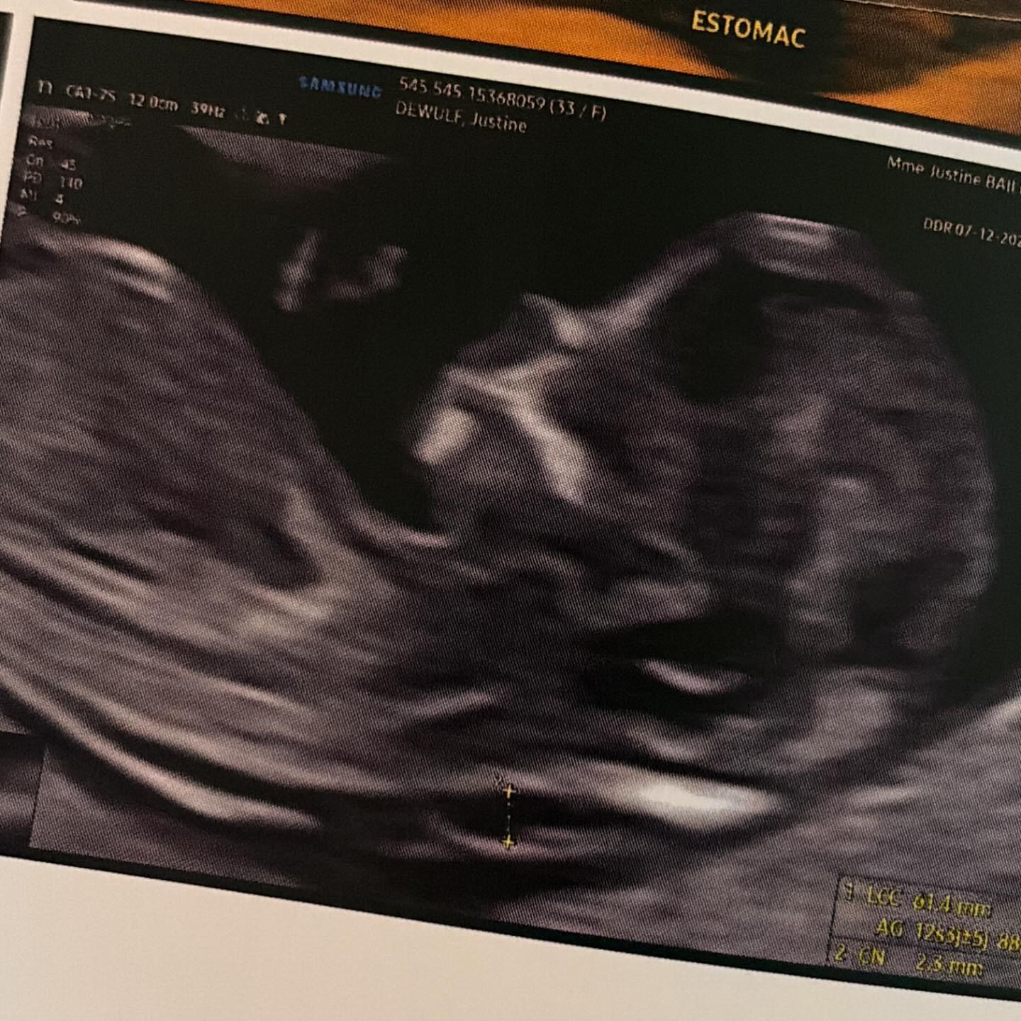 À toi Mon petit bébé,
Ces jours-ci, j’avais prévu de partager une jolie photo de notre famille pour annoncer une merveilleuse nouvelle : notre famille allait s’agrandir. Depuis 14 semaines, je te portais tout contre moi, avec déjà tellement d’amour. Tu faisais déjà partie de nous, de notre histoire, de notre famille.
J’avais imaginé tant de choses, tant de moments à partager avec toi… et pourtant, tu as choisi de venir nous rencontrer bien trop tôt.
Le 8 mars 2026 restera à jamais gravé dans mon cœur, le jour où j’ai dû te dire au revoir.
Merci pour tout l’amour que tu nous as déjà donné en si peu de temps. Merci de nous avoir choisis, même pour ce court instant.
Même si la douleur est immense, nous garderons à jamais dans nos cœurs ces semaines remplies de bonheur et d’espoir.
Tu resteras à jamais notre petit bébé, une partie de nous, pour toujours.
À toi mon Basile
Je t’aime pour l’éternité. 🤍