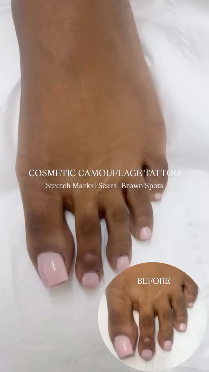 COSMETIC CAMOUFLAGE TATTOO
You’re not “being dramatic.”
If a scar, stretch marks, or pigmentation has been making you hide your skin... I get it.
Camouflage tattooing is a specialist technique designed to blend the area with your natural skin tone so it’s less noticeable and often a huge confidence shift).
This can be great for:
• Scars (once fully healed)
• Stretch marks
• Hypopigmentation / lighter patches (case-dependent)
• Areas that make makeup feel like a full-time job
DM “CAMO” to get rid of your unwanted scars today.
#camoflauge #camoflaugetattoo #scars #stretchmarks #oldbury