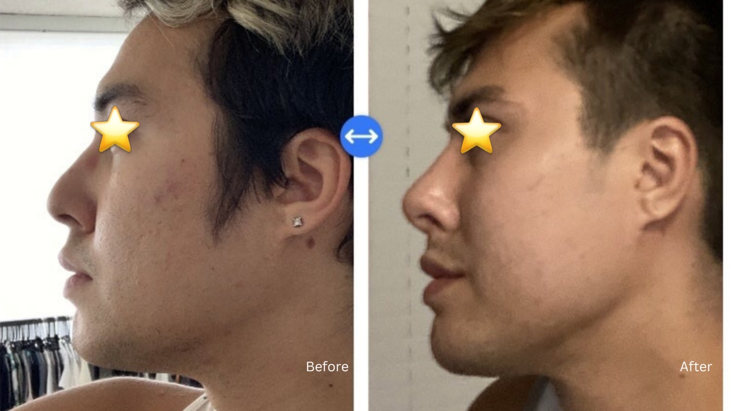 Not just for women—rhinoplasty is one of the most popular procedures for men looking to enhance their profile. 👃🏻
This patient chose to smooth the bump along his bridge for a cleaner, more balanced look while still maintaining his natural features.
Confidence starts with feeling like your best self.
📞 Call today to schedule your consultation with Dr. Chu. 808-524-1551
.
.
.
#HawaiiPlasticSurgery #BoardCertifiedSurgeon #rhinoplasty #NaturalLookingResults #Drbenchu