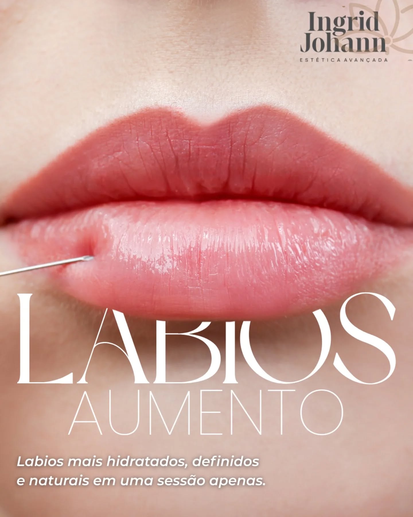 💋 Lábios com mais volume, hidratação e definição… sem perder a naturalidade ✨
O aumento labial vai muito além de volume — é sobre equilíbrio, proporção e realçar a sua beleza de forma sutil e harmônica 💖
Com o uso de ácido hialurônico, é possível conquistar lábios mais contornados, hidratados e com aquele aspecto saudável já na primeira sessão 👌
💭 Resultado natural, respeitando o seu formato e a sua essência.
📲 Agende sua avaliação e descubra o formato ideal para você!
#labios s #preenchimentolabial #ácidohialurónico #belezanatural #harmonizaçãofacial