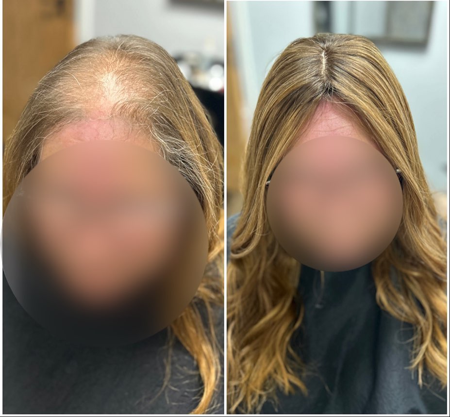 Another new system. This lady has had an awful lot of stresses in her life, I was so saddened to hear what she’s had to endure. Any physical or emotional stress can have such a negative impact on your hair. I think she is beautiful inside and out ❤️ .
.
.
.
.
.
#lacetopwigs #lacefrontwigs #lacewigs #wigs #lacefrontal #alopecia #areata #hairloss #hairreplacements #bespokewigs #customcolouredwigs #handmadewigs #wigbuilding #hairintegration #laceintegration #hairextensions #weave #hairlossspecialist #trichologist #trichology #hairlosssolution #hairlosssalon #hair #telogeneffluvium #stress #fphl #femalehairloss