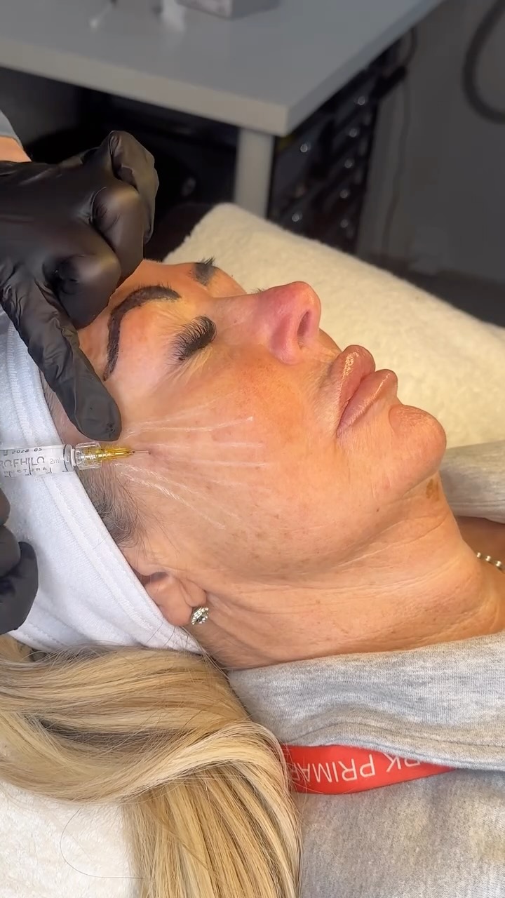 As we age, the soft layer under our skin (fat + tissue) becomes weaker and less supportive.
Profhilo Structura helps improve that support, so your skin sits better, looks smoother, and feels firmer — without looking overfilled.
Comment ‘PLAN’ and I’ll tell you what your face actually needs.
#antiaging #aestheticclinic #aestheticclinicliverpool #skinclinic #liverpool