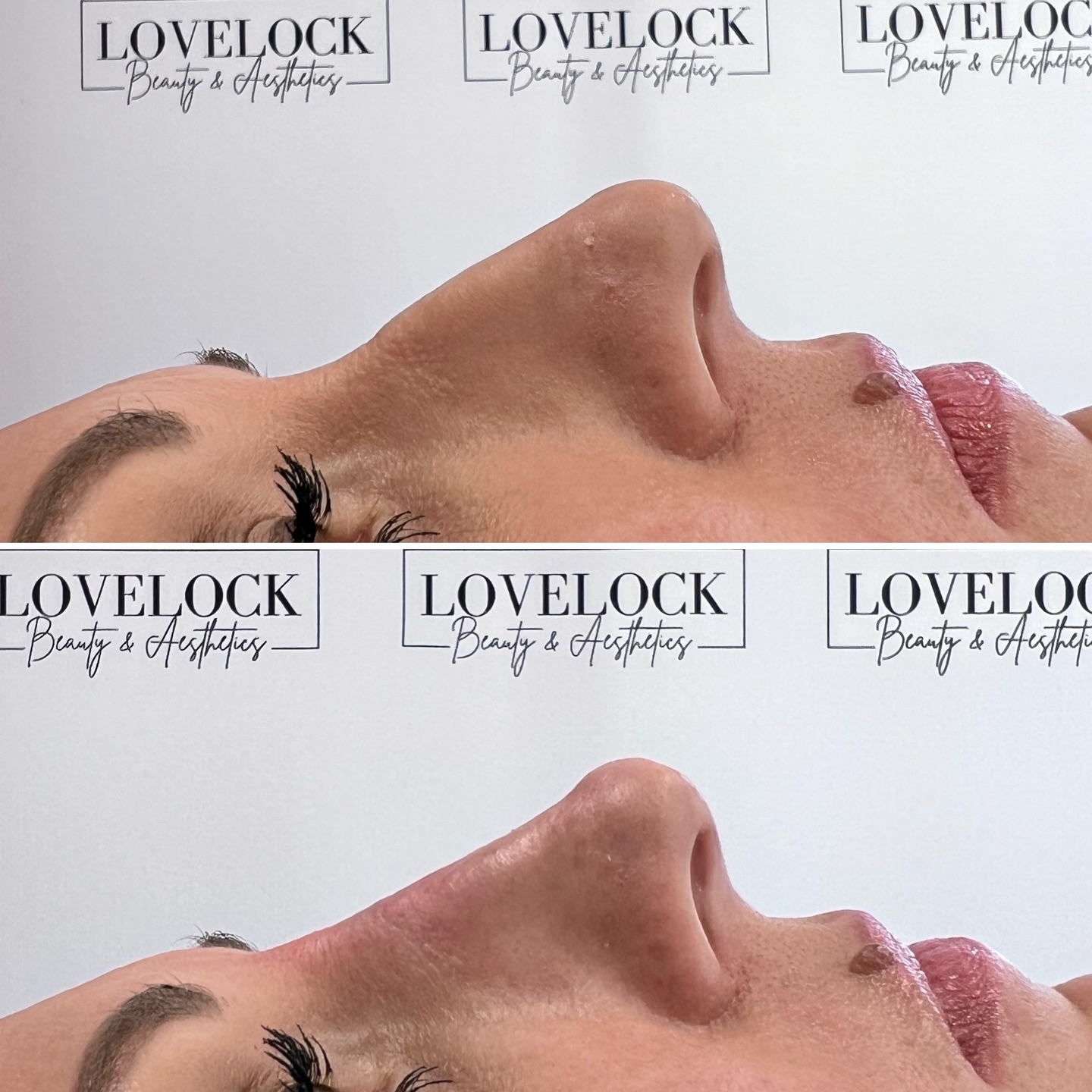 Another amazing transformation on my client!
If you don’t like the side profile of your nose, it can easily be fixed.
please feel free to get in contact.
⭐️ Award-winning level 7 aesthetic practitioner
📍 Romsey 📍 Warminster
#warminster #westbury #trowbridge #romsey #romseylife