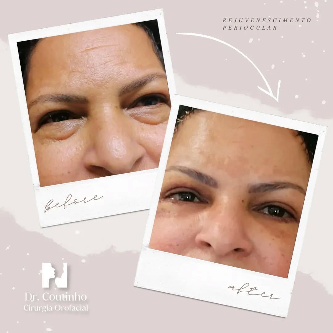 Transformação visível: antes e depois do rejuvenescimento periocular. 🌟
Combinando a arte do brow lift, da blefaroplastia superior e inferior e do midface lift é possível transformar não apenas a aparência, mas também a função e a sua auto-estima ao olhar no espelho. Veja a diferença que uma abordagem combinada pode fazer, trazendo de volta a juventude e o brilho aos seus olhos.
#RejuvenescimentoPeriocular #AntesEDepois #BelezaNatural