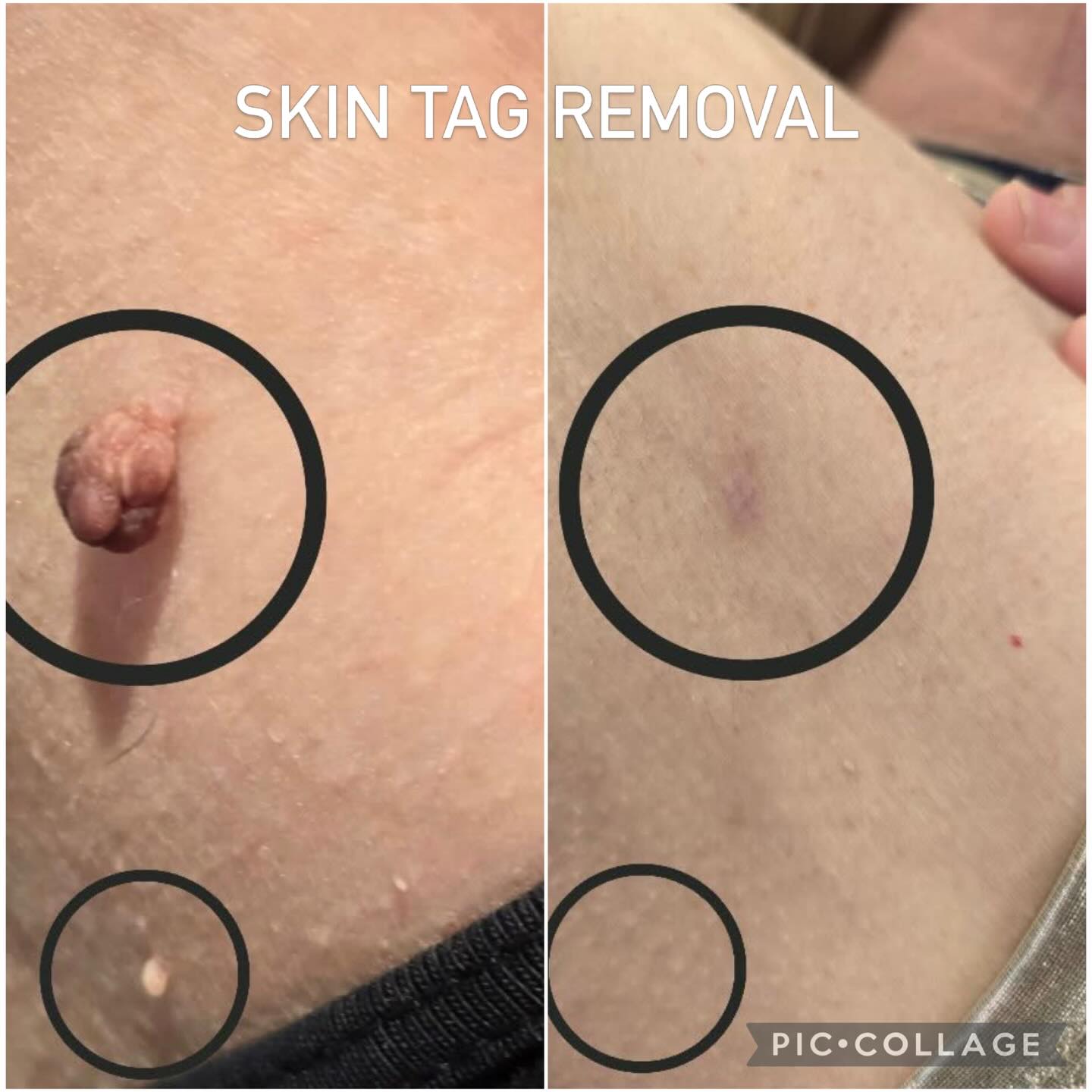 Clearer, smoother skin starts here ✨
Using advanced plasma pen technology, we can safely and effectively treat a range of common skin concerns including skin tags, seborrheic keratosis, warts, xanthelasma, and pigmentation.
This precise treatment works by creating tiny micro-traumas on the skin’s surface, encouraging natural healing and regeneration for a fresher, more even complexion.
✨ Non-invasive
✨ Minimal downtime
✨ Targeted, accurate results
Reveal healthier, clearer skin with confidence.
#PlasmaPen #SkinTagRemoval #SkinClinic #ClearSkinJourney #aesthetictreatments