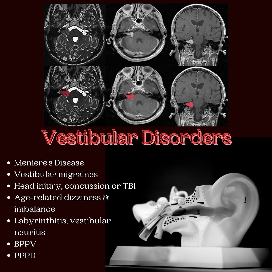 Vestibular Dysfunction
Vestibular conditions are a group of invisible disabilities most people aren’t aware of until you see someone who is dizzy and most often are mistaken for being intoxicated or crazy. Never judge a book by its cover. These conditions are life altering and can interfere with living a normal life. There are many challenges everyday just to get out of bed without the world spinning like the tilt-a-whirl at the fair. These conditions are associated with primary symptoms of chronic dizziness & vertigo, disequilibrium, vestibular migraines, hearing loss, tinnitus, and impaired balance. Secondary symptoms are anxiety, brain fog, cognitive impairment, falling, injuries, depression, and isolation. These conditions may result from a structural problem within the inner ear, heart problems, vision loss, dehydration, stress, and trauma.
Compassion and loving support is vital in helping others manage these life altering conditions. Finding balance (definitely no pun intended) in an unbalanced world is a constant crusade that has many challenges but CAN be overcome with quality trusting health care providers, proper testing (OAT, heavy metals, toxins), and a bio-individual whole-person approach to care. If you ever see someone who is struggling, offer a hand, ask how you may be able to support them. I find most often people are scared to ask for help, I know I was. Be the person who helps break down the barriers to change our health disparities. You could possibly change someone’s life in the most profound way.
Be well!
#healthcoach #holistichealth #healthgoals
#healing #healtheducation #holisticnutrition
#holisticpractitioner #liveyourtruestself #inspiration
#mentalhealth #mentalhealthamerica #resilience
#wellbeing #wellnesscoaching #wellnessjourney
#vestibularveda #dizziness #vertigo #invisibledisability #invisibledisabilities