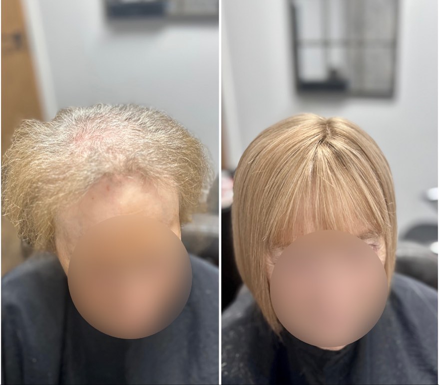 This lady always makes my day when she visits the salon ❤️. Yesterday she was due her realignment, we took her system off cleaned everything up and gave her a scalp treatment and then refitted her system. .
.
.
.
.
.
.
#lacetopwigs #lacefrontwigs #lacewigs #wigs #lacefrontal #alopecia #areata #hairloss #hairreplacements #bespokewigs #customcolouredwigs #handmadewigs #wigbuilding #hairintegration #laceintegration #hairextensions #weave #hairlossspecialist #cancerawareness #trichologist #trichology #hairlosssolution #hairlosssalon #hair #cancerhairloss #cancer