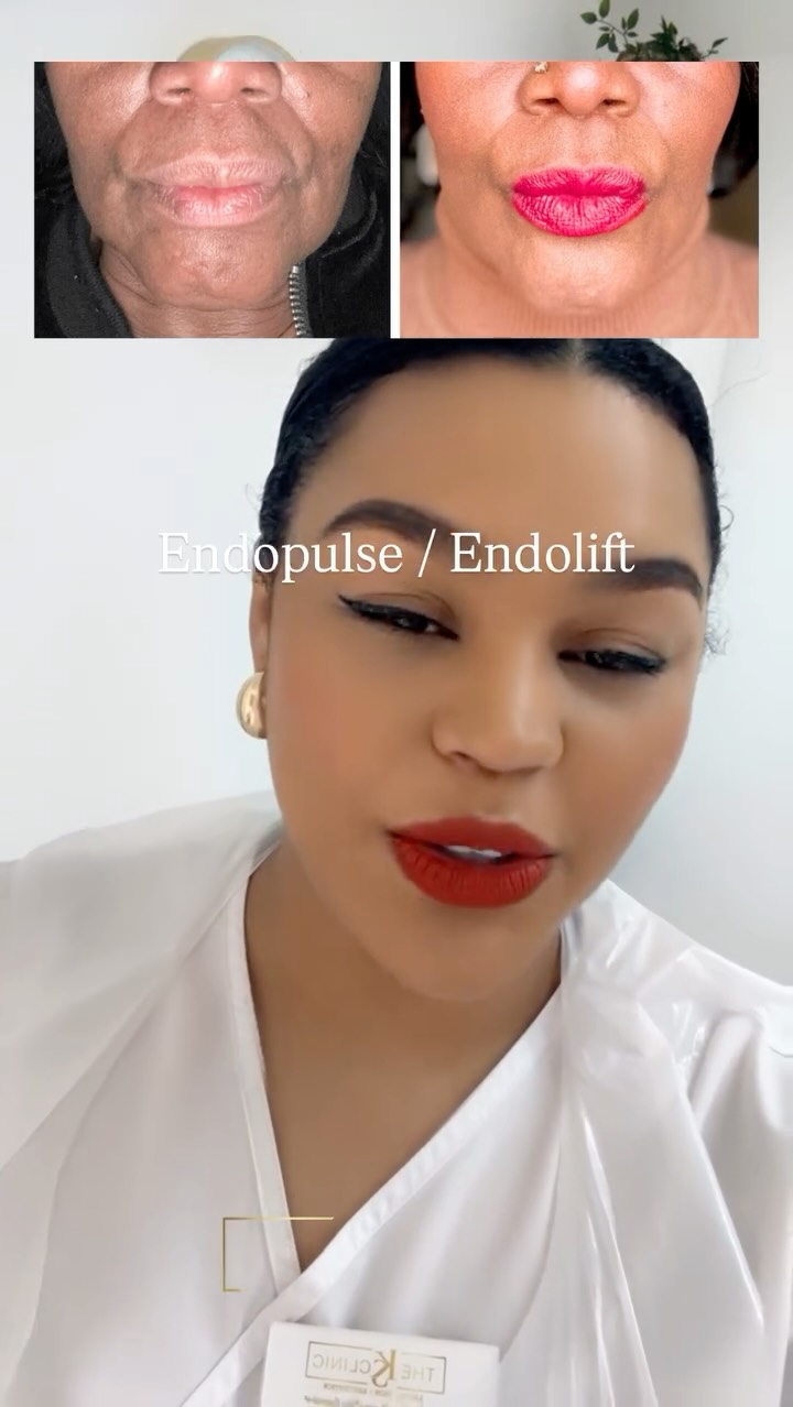 We have been busy performing non surgical Endolift face lifts for our clients and the results are starting to show.
Results after just 2 weeks.
Best results after 4-6 weeks.
Results last up to 3 years.
The only treatment that gives a very noticeable lift and tightening and that lasts after just 1 procedure.
If you would like more info DM “FACELIFT”
#endolift #skintightening #skinlifting #facelift #oldbury