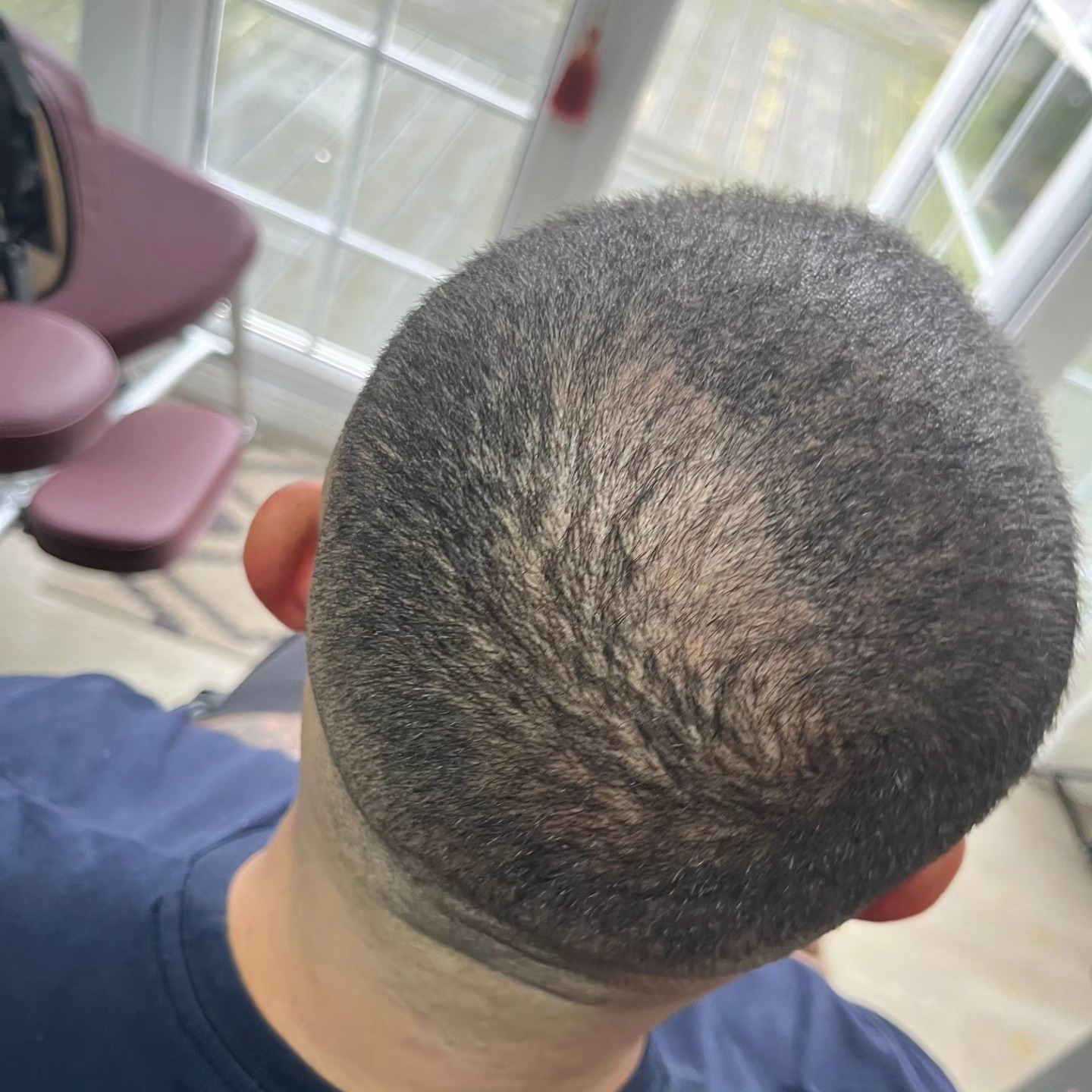 DENSITY
Adding Scalp Micro-Pigmentation to transplanted hair to create the look of thicker, fuller hair!
You can see the difference what a difference it makes in the first picture!
Results from first session!
#menshair #hairloss #hairgrowth
#hairregrowthtreatment
#balding #hairtransformation
#hairtransplant #hairtattoo #scalppigmentation #scalpmicropigmentation #smp