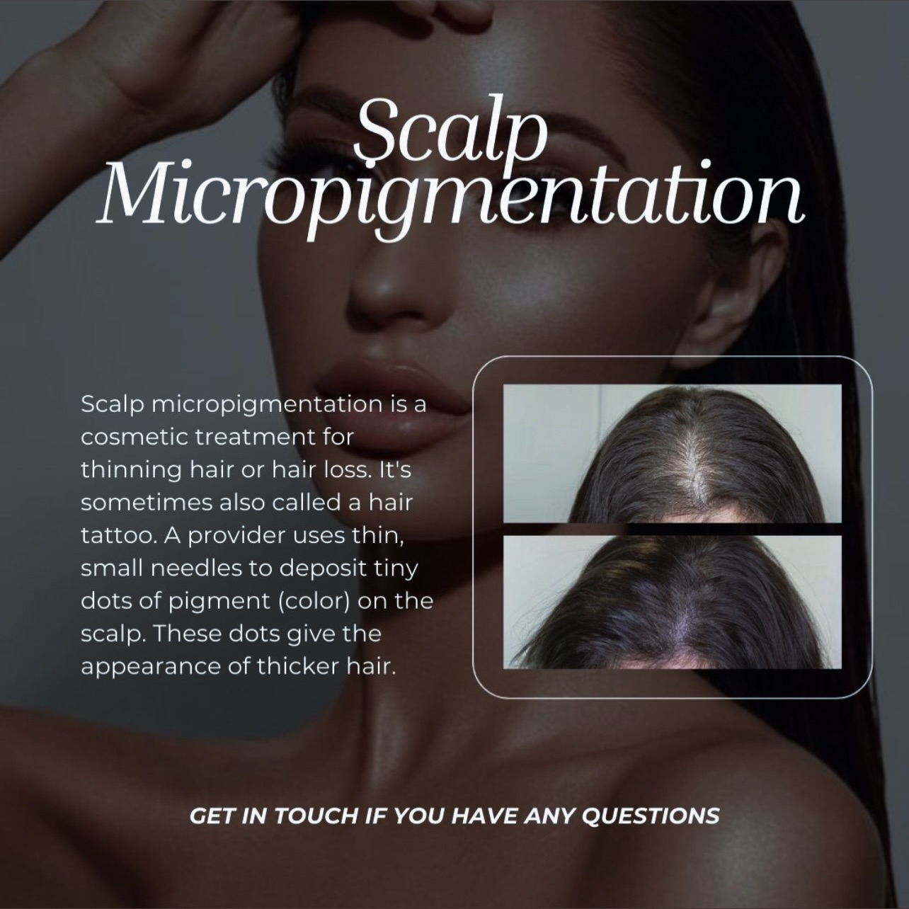 Now Accepting Consultations For #ScalpMicropigmentation
This service is for both male and female candidates who desire more density and fullness due to hairloss or thinning.
BEATANDBLADE.COM
#smp #hairloss #beforeandafter hairtatto