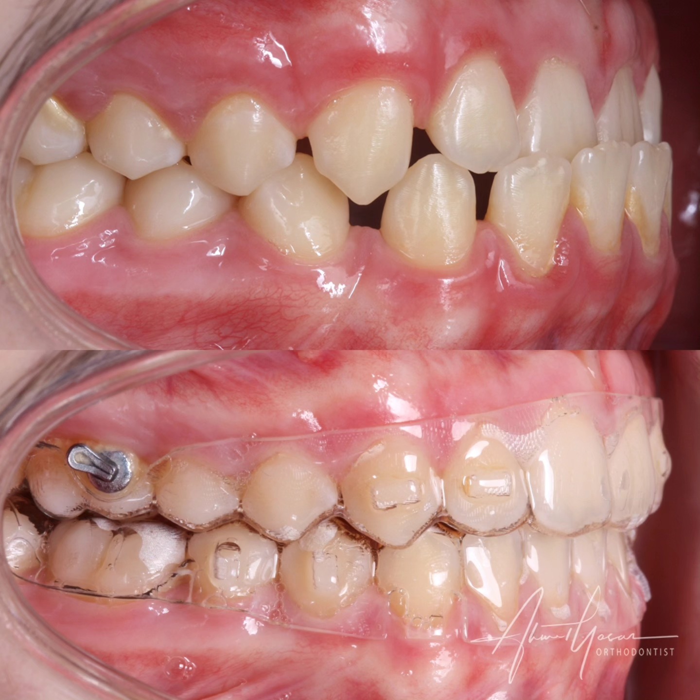 Anterior crossbite treatment with clear aligners.
.
Our clinic is authorized by the Ministry of Health of the Republic of Türkiye for International Health Tourism. All patients have been informed and have provided consent for the use of their photographs on our social media platforms. All content shared on social media is intended to inform patients about procedures and should not be perceived as advertising. Outcomes of any surgical or interventional treatment may vary from person to person. It is recommended to consult your physician for detailed information before undergoing any procedure.
.
.
#ortodonti #ortodontist #bursa #bursaortodonti #bursaortodontist #bursaortodontiuzmanı #orthodontics #braces #teltedavisi #dişteli #orthognathicsurgery #invisalign #clearcorrect #şeffafplak #lingualortodonti #dişteli #çeneameliyatı #selfligating #kapaklıbraket #gülüştasarımı #dent #dentistry #photography #estetik #dentalart #ahmetyasar #drahmetyasar