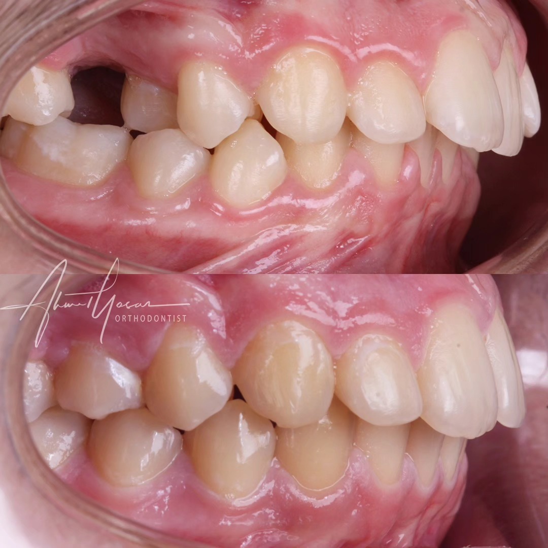 Birinci büyükazı dişleri, erken yaşta (6 yaşında) ağız içine sürdükleri için maalesef en çok çürüyen ve çekilen daimi dişlerden biridir. Ortodonti ile çekilen 1. büyükazı dişlerinin boşluğunu arkadaki 2. büyükazı dişiyle kapatmak mümkündür.
.
Our clinic is authorized by the Ministry of Health of the Republic of Türkiye for International Health Tourism. All patients have been informed and have provided consent for the use of their photographs on our social media platforms. All content shared on social media is intended to inform patients about procedures and should not be perceived as advertising. Outcomes of any surgical or interventional treatment may vary from person to person. It is recommended to consult your physician for detailed information before undergoing any procedure.
.
.
.
#ortodonti #ortodontist #bursa #fsm #bursaortodonti #bursaortodontist #bursaortodontiuzmanı #orthodontics #braces #teltedavisi #invisalign #invisalignbursa #şeffafplak #lingualortodonti #lingualorthodontics #dişteli #ortholove #selfligating #kapaklıbraket #gülüştasarımı #dent #dentistry #art #picoftheday #photography #estetik #dentalart #ahmetyasar #drahmetyasar