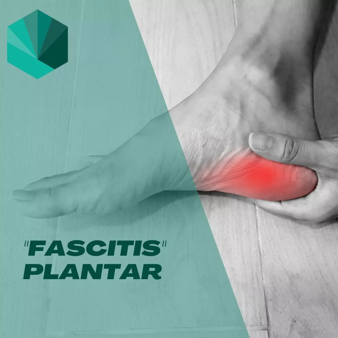 📢 "FASCITIS PLANTAR". Bueno... más bien FASCIOPATIA PLANTAR, que es el término actualizado para este tipo de lesión, ya que se ha demostrado que no hay proceso inflamatorio presente.
🦶 Se caracteriza por ser un dolor localizado en la zona anterior del talón que se reproduce cuando damos los primero pasos del día y que desaparece a medida que "calienta" la zona.
💢 Hay muchos factores de riesgo que pueden llegar a generar este dolor plantar. Pero los más habituales son el uso de calzado inadecuado durante largo periodos de tiempo o la realización de actividades exigentes para el pié (como hacer caminatas largas sin preparación previa).
📝Para realizar un buen diagnóstico hay que tener en cuenta la historia clínica y sintomatología del paciente, para hacer un buen diagnóstico diferencial, ya que no todo dolor plantar es "fascitis".
🤸🏽♂️Su tratamiento es complejo por ello es importante abordarlo con diferentes técnicas como el uso de taloneras, fisioterapia, cambios de hábitos, ejercicios... Siendo importante el trabajo multidisciplinar con podólogo en caso de ser necesario.
💚 ¡Si tenéis dolor similar no dudéis en contactar con nosotros para poder ayudaros!