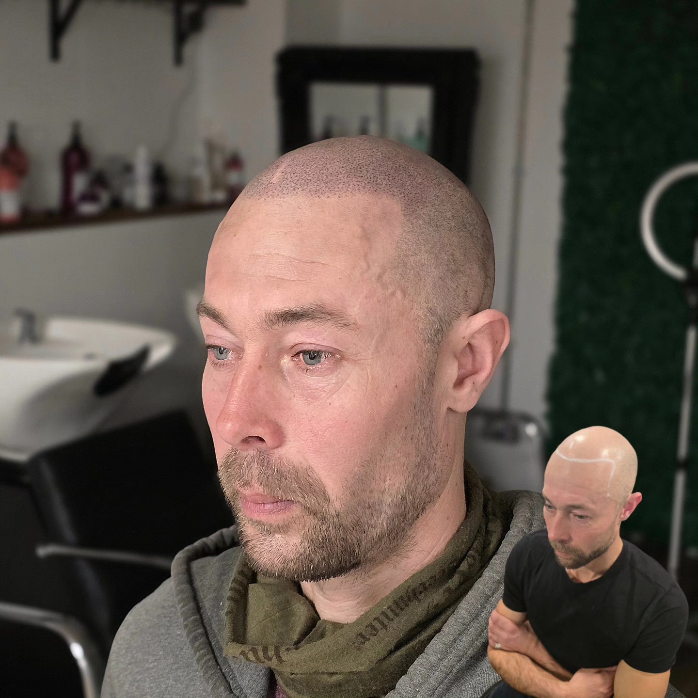 SMP TRANSFORMATION
Realistic results ✔️
Natural hairline restored ✔️
Looks years younger ✔️
Confidence boosted ✔️
Full head treatment done over 3 sessions spread over a couple of weeks
📍Bury St Edmunds
.
.
.
.
.
#smp #scalppigmentation #scalpmicropigmentation #smptraining #hairtransplantalternative #hairlosssolution #hairloss #hairline #hairfibres #hairtransplant #fakehair #hairtattoo #scalptattoo #newhair #hairsystem #hairgrowth #balding #receding #hairfall #goingbald #bald #shavedhead #buzzcut