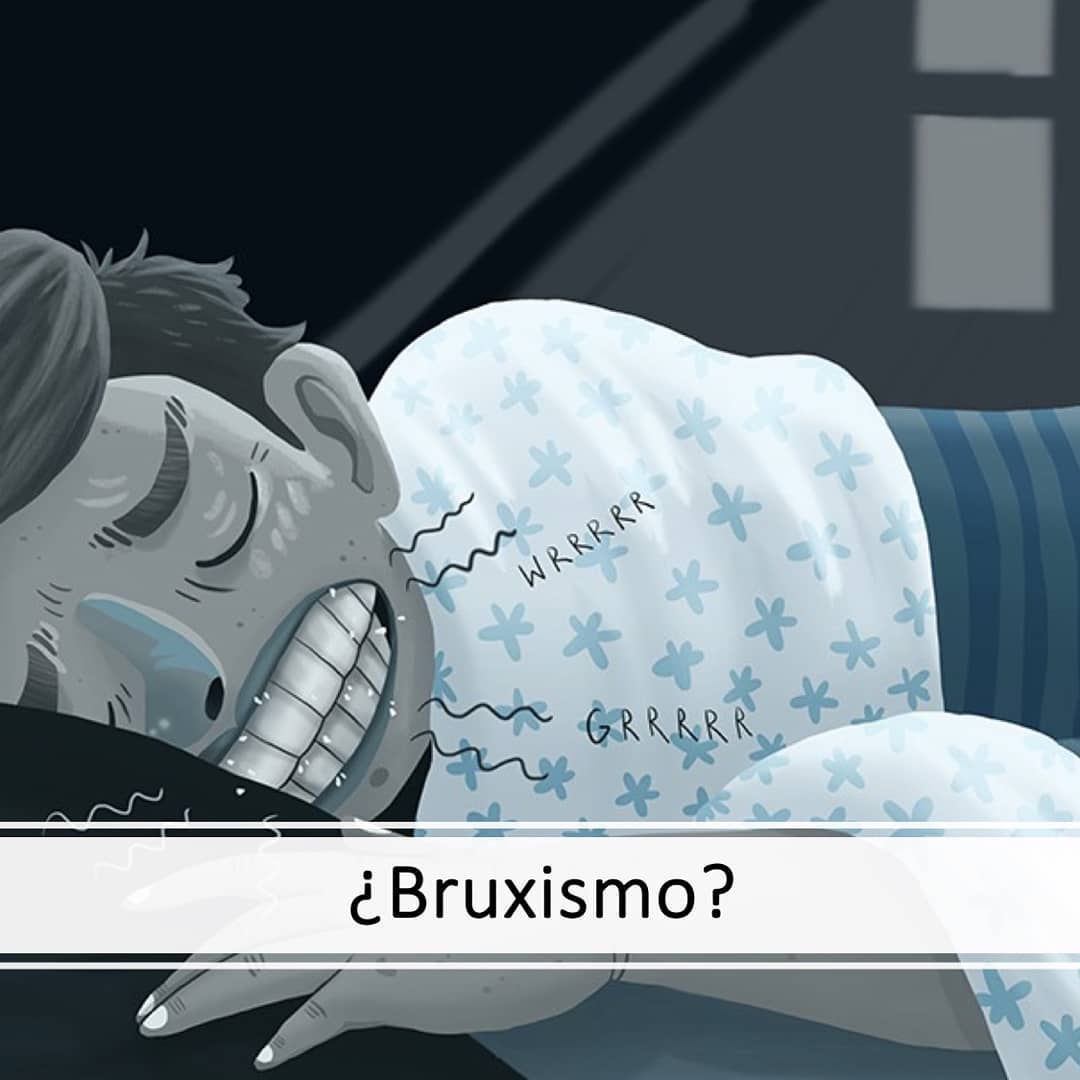 El #bruxismo tiene dos formas de presentación, cuando estamos despiertos (#bruxismodevigilia) o cuando estamos durmiendo (#bruxismodelsueño). El bruxismo de vigilia es considerado un mal hábito y el bruxismo del sueño requiere una recolección de información de cómo es el dormir, ya que en su mayoría, es secundario a otras enfermedades que se presentan en el sueño. Del bruxismo del sueño, se estima una prevalencia en adultos de un 5,5% (con polisomnografía) y, en niños, rangos que van desde 3,4% al 40,6% (y no se considera como algo "normal" en niños‼️🚫).
⬇️
🔷Tienes dudas? 👩💻👨💻 Visita nuestra página web www.dolorfacialsur.cl y conoce más de nuestra especialidad. ⬇️
🏥 Necesitas un diagnóstico? Puedes agendar tu hora a través de nuestra página web o en nuestro WhatsApp📱 +569 8893 9493 📞
⬇️
🌐Referencias:
➡️Polysomnographic study of the prevalence of Sleep bruxism in a population sample.
➡️Prevalence of sleep bruxism in children: a systematic review.
#temucochile #Temuco #Angol #araucania #odontologia
#dolororofacial #ttmydof #ttm #salud
#dentista #orofacialpain #bruxismo
#consultas #tmdpain #clinica #dental #instatemuco #salud #research