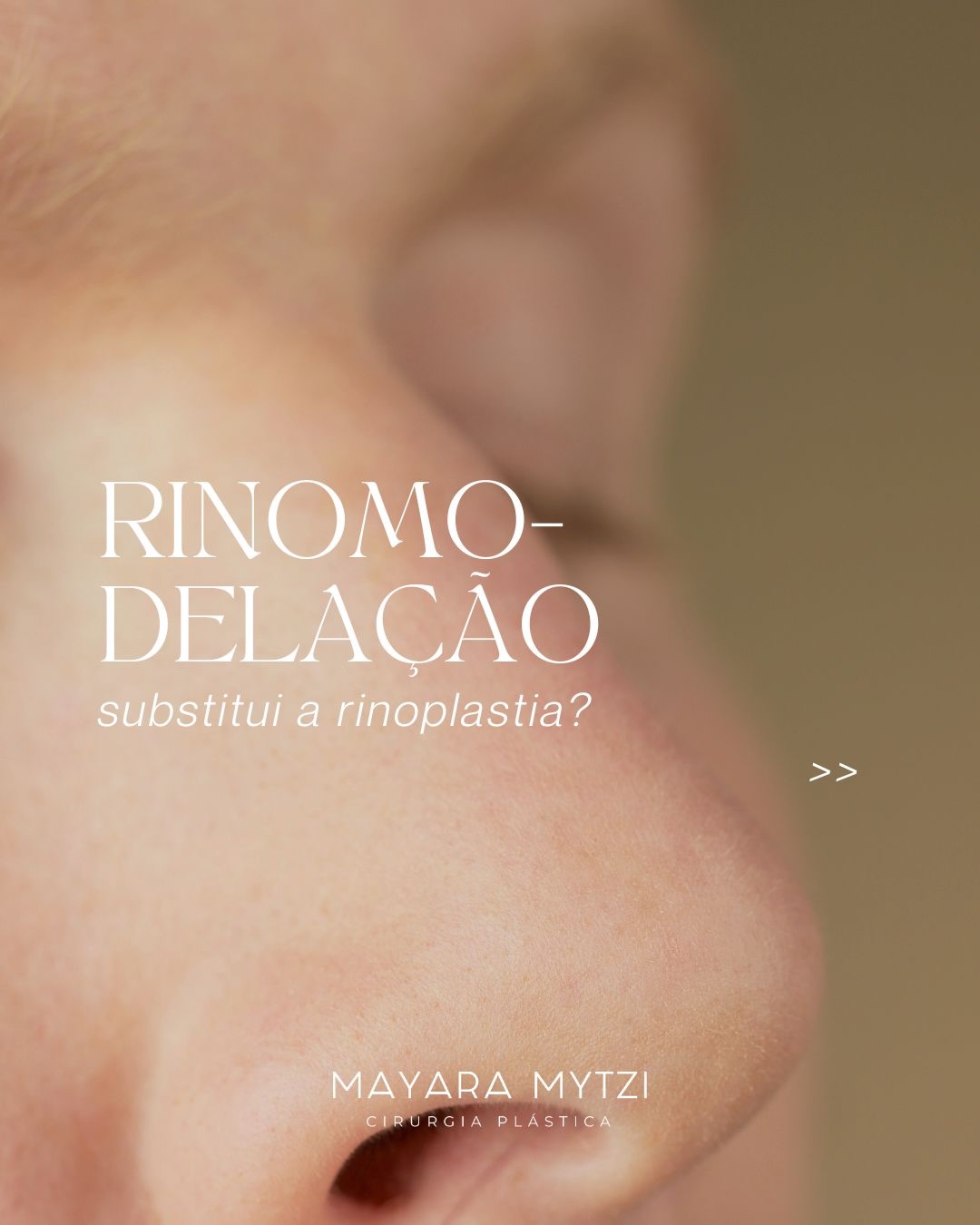 A rinomodelação, feita com preenchimento, pode camuflar pequenas irregularidades no dorso nasal e melhorar discretamente o contorno do nariz. Por ser um procedimento não cirúrgico, muitas vezes é vista como alternativa à rinoplastia.
No entanto, ela possui limitações importantes: não reduz o nariz, não corrige a estrutura nasal e seus resultados são temporários. Além disso, a região do nariz é uma área vascular delicada, que exige extrema cautela.
A rinoplastia, por outro lado, permite tratar a estrutura nasal de forma definitiva, com resultados mais previsíveis e duradouros, além de promover uma melhora funcional em casos de dificuldades respiratórias.
Por isso, o seu caso precisa de uma avaliação médica criteriosa para definir a indicação correta.
Dra. Mayara Mytzi
CRM SP 136.044 • Médica
Cirurgiã Plástica • RQE 66881
#dramayaramytzi
#cirurgiaplastica