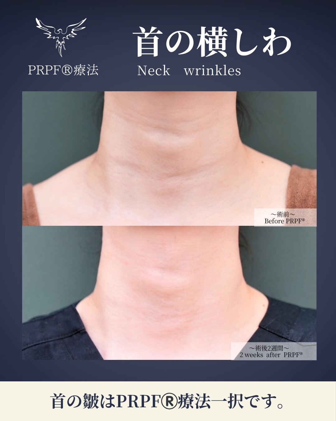 .
.
【施術内容】
PRPFをJUVA penで深層と浅層と二層に分けて精密に注入。
【年代】
30代:女性
【施術費用】
PRPF2.2cc
¥220,000(税込)
【ダウンタイム】
約1週間
【副反応・リスク】
発赤、皮下出血斑、腫れ(約1週間程度)
ーーーお問い合わせーーー
インスタグラムプロフィール欄から
簡単にLINE登録が出来ますので、
そちらからお気軽にお問い合わせ下さいませ。
♬モニター様も募集中♬
Jóia Clinic Kyoto
TEL:075-229-6388
診療時間 10:00~18:00
休診日 日・月・祝
#ジョイアクリニック#PRPF#首のシワ