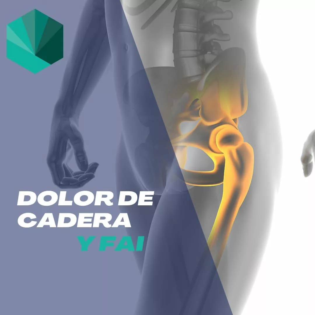 🙋🏽♂️ FAI! O Alteración Femoroacetabular, es término que se acuñó hoy en día para describir una de las muchas alteraciones morfológicas de la cadera.
📚 Esta alteración se debe a un choque prematuro cuando realizamos flexión de cadera. Pudiendo ser provocado por una aumento de tamaño de la cabeza del fémur o un exceso de crecimiento de tejido del labrum.
🧐 Actualmente se ha demostrado la presencia de estas alteraciones en población asintomática. Eso quiere decir que no tiene porqué generar dolor.
📝En caso de dolor. La característica clínica principal es el Signo de C donde el paciente de abraza la cadera con la mano por la parte lateral hacia la ingle.
🏋🏻♀️ El tratamiento de fisioterapia se centrará en el manejo del dolor y la mejora de la función. En casos extremos o donde haya fracaso del tratamiento conservador se procederá a intervenir quirúrgicamente.
💚Hace mucho tiempo que no nos pasamos por aquí... ¡Esperemos que os guste!
