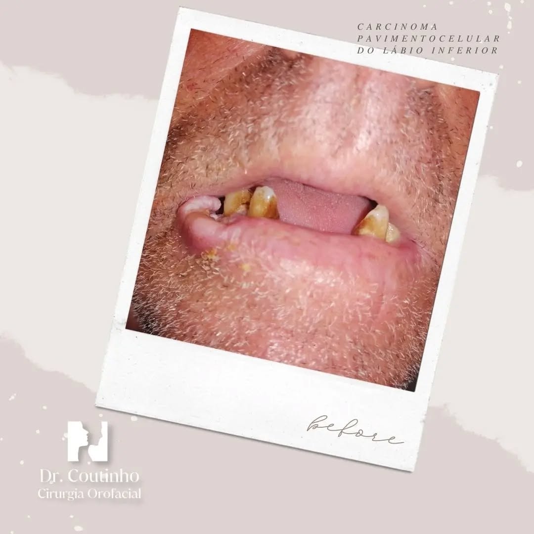 👄 Metade cirurgião e metade artista. 👨🏼🎨
Este caso de reconstrução do lábio inferior ilustra a complexidade e a beleza da cirurgia reconstrutiva facial. Desafiados por um defeito significativo que afetava a comissura labial, optamos por uma abordagem híbrida combinando o retalho de Karapandzic, que preserva a musculatura peri-oral e a função do lábio, com o retalho de Bernard-Webster, que protege a comissura e previne a microstomia.
A escolha criteriosa da técnica não só restaurou a estética, como garantiu a recuperação da função labial, permitindo que o nosso paciente sorrisse novamente com confiança. Cada passo foi calculado para alcançar o equilíbrio perfeito entre a forma e a função.
#CirurgiaReconstrutiva
#TransformaçãoFacial
#ArteMédica
#AnteseDepois