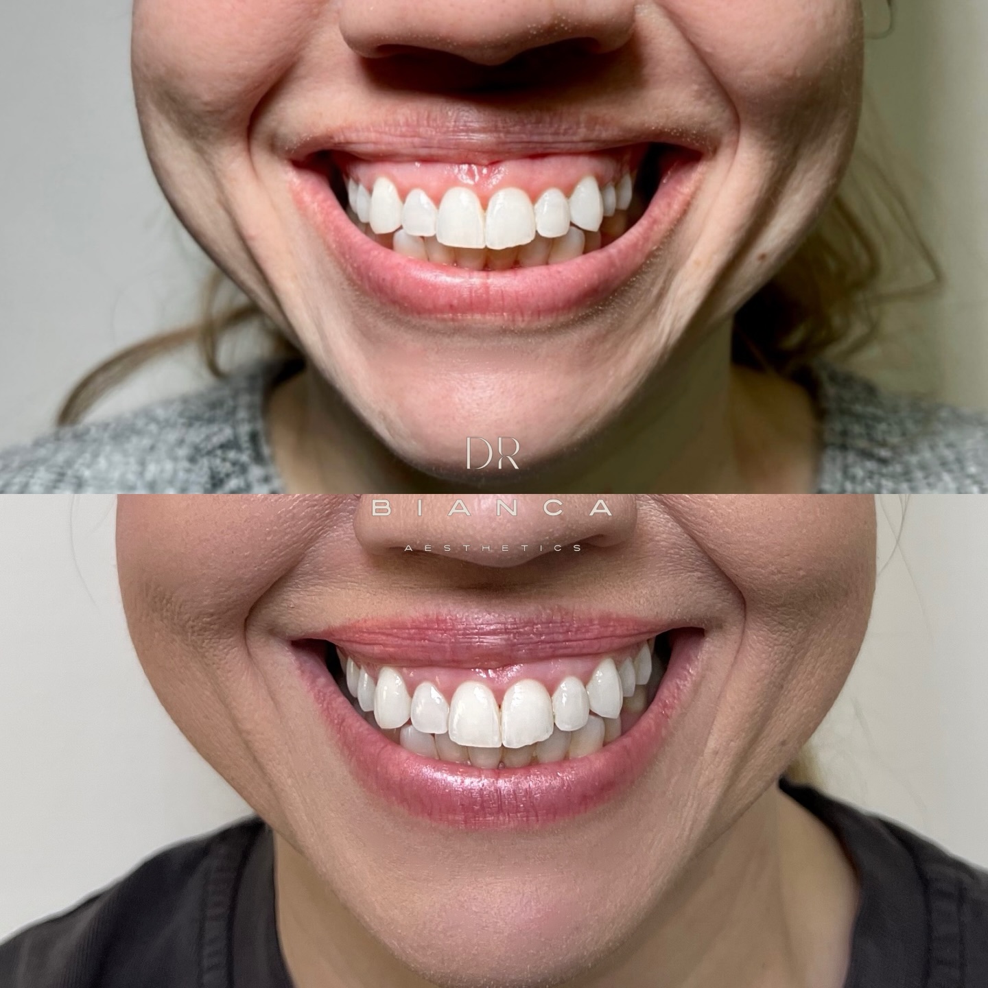 ✨ More than just a lip flip 💋
Before & After
This transformation included:
– Gummy smile correction
– Subtle lip flip
– DAO treatment to lift the corners of the mouth
Treating the full smile dynamic creates a softer, more balanced result.
Important: this area is easy to over-treat. Too much can impact natural movement, speech, and expression.
Less, done well, is always more.
Book here:
www.doctorbianca.co.uk
#LipFlipUK #GummySmileTreatment #DAO #NaturalAesthetics #AestheticResults