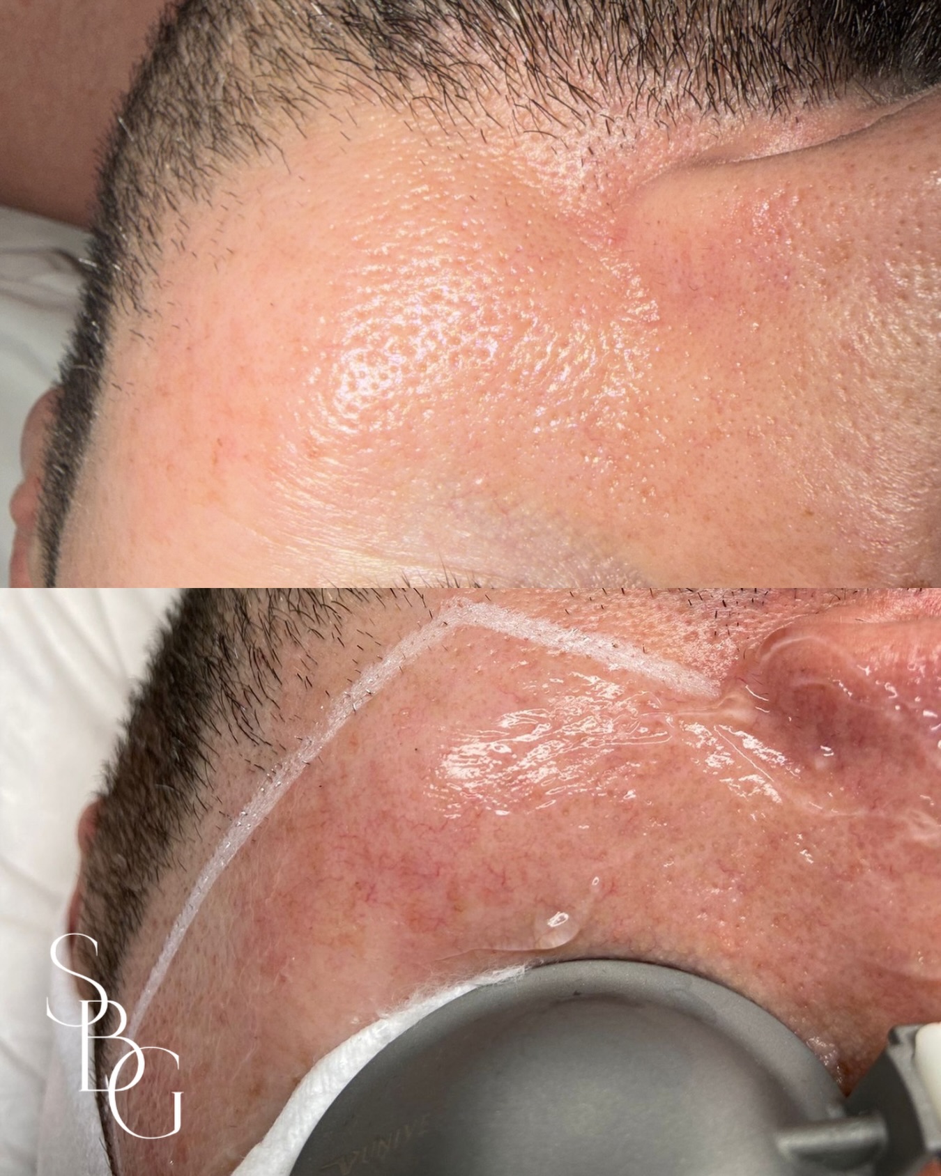 The power of just 1 IPL session⚡️
IPL (intense pulsed light) is a non-surgical cosmetic treatment that uses broad-spectrum light to improve the appearance of the skin, specifically targeting hyperpigmentation, thread veins, rosacea and redness
Light is absorbed into the skin and turned into heat, helping to break down unwanted pigment and vascular concerns, leading to a more even skin tone
Skin is also left feeling rejuvenated, firmer and more plump. We do always advise courses of treatments between 3-6 to deliver intense, long lasting results✨
For more information or if you’d like to book a consultation, get in touch now⬇️
📞07760 878798
🌐www.skinbygrace.online
📧sbgcliniq@outlook.com
#iplskinrejuvenation #lyntonlasers #threadveinremoval #pigmentationtreatment #skinrejuvenation