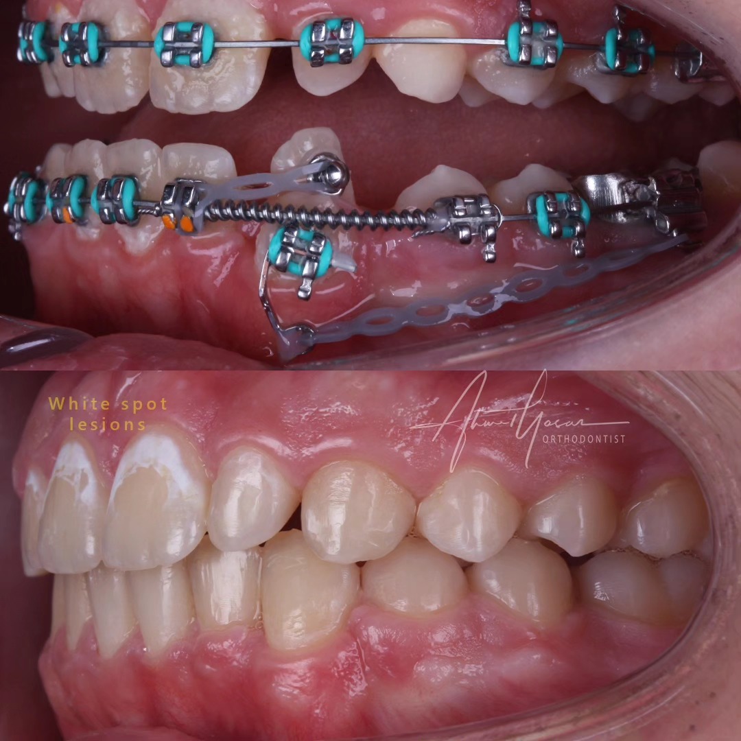 Tretment of malpositioned canine.
P.S. Oral hygiene is very important during ortho treatment. Bad hygiene may cause white spot lesions, caries and gum diseases.
.
Our clinic is authorized by the Ministry of Health of the Republic of Türkiye for International Health Tourism. All patients have been informed and have provided consent for the use of their photographs on our social media platforms. All content shared on social media is intended to inform patients about procedures and should not be perceived as advertising. Outcomes of any surgical or interventional treatment may vary from person to person. It is recommended to consult your physician for detailed information before undergoing any procedure.
.
.
.
#ortodonti #ortodontist #bursa #fsm #bursaortodonti #bursaortodontist #bursaortodontiuzmanı #orthodontics #braces #teltedavisi #invisalign #invisalignbursa #şeffafplak #lingualortodonti #lingualorthodontics #dişteli #ortholove #selfligating #kapaklıbraket #gülüştasarımı #dent #dentistry #art #picoftheday #photography #estetik #dentalart #ahmetyasar #drahmetyasar
