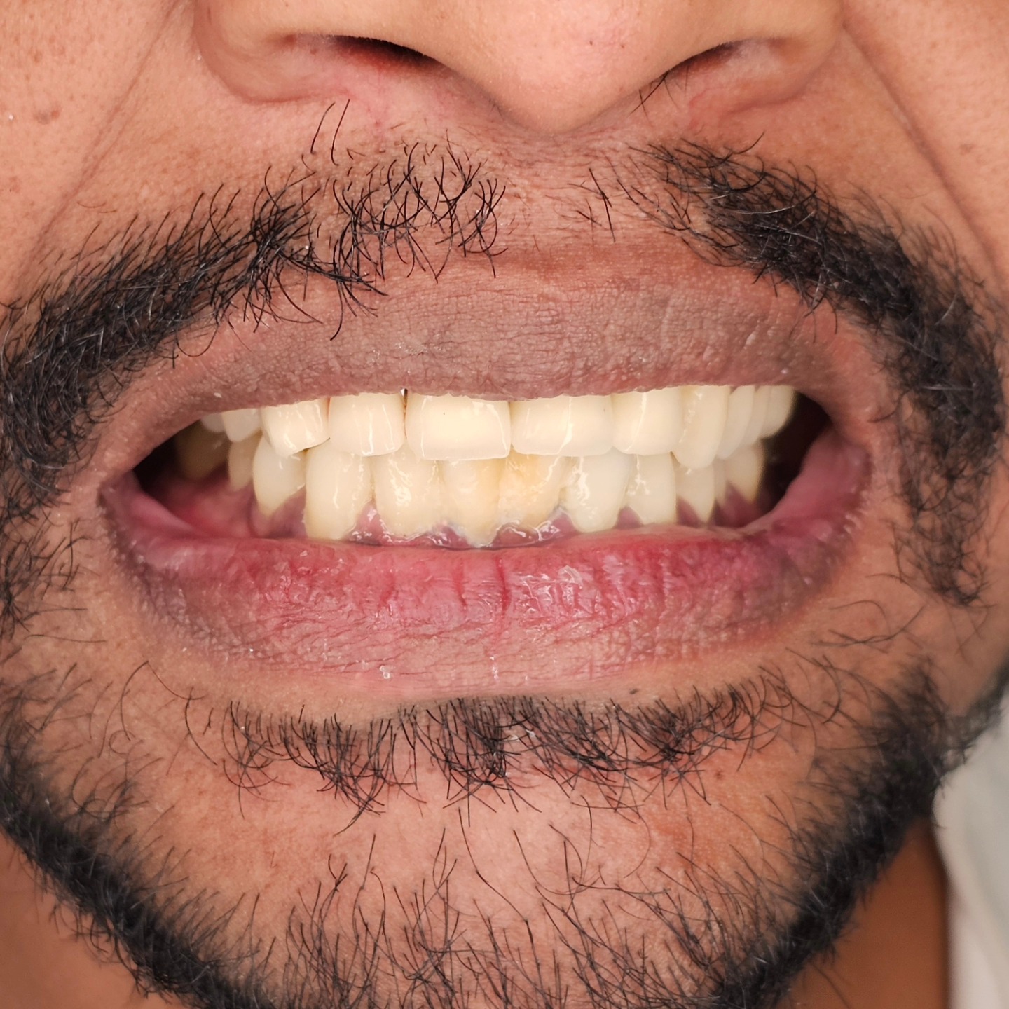 A case of Regenrative Dentistry with beautiful outcome .
Combined effort of surgery, endodontics, periodontics and Prosthodontics at Sethu's Dental House.
Thanks to our surgeon Dr. Karthik Ramakrishnan ,
Endodontist Dr. Ashwin Ravichandran, Prosthodontist Dr. Sethuraman Ramadoss.
1. Current smile of patient.
2. & 3. Preoperative picture showing radicular cyst in relation to lateral incsior 12.
4. & 5. Removal of existing restoration showing poor condition of post and core
6. Open flap elevation and Cyst enucleation , apicoectomy and retrograde MTA restoration of 12.
7. & 8. Guided bone regeneration with Beta TCP and HA synthetic bone graft Q-Oss+ and Ossmem collagen membrane. @osstemindia
9. Surgical site Closure .
10. Post and core build up of the incisors repreparation to establish proper margin and eminence profile , restored with PMMA joint crowns for givgival margin contouring and splinting.
11. Pre op vs post op (3 months) xray showing good bone formation
12. Final individual DMLS PFM crowns after 3 months. Lab support by @banyan_dental_lab
#osstem #regeneration #smiledesign #graft #regenerativedentistry #gbr #gtr #dentistry #aesthetic