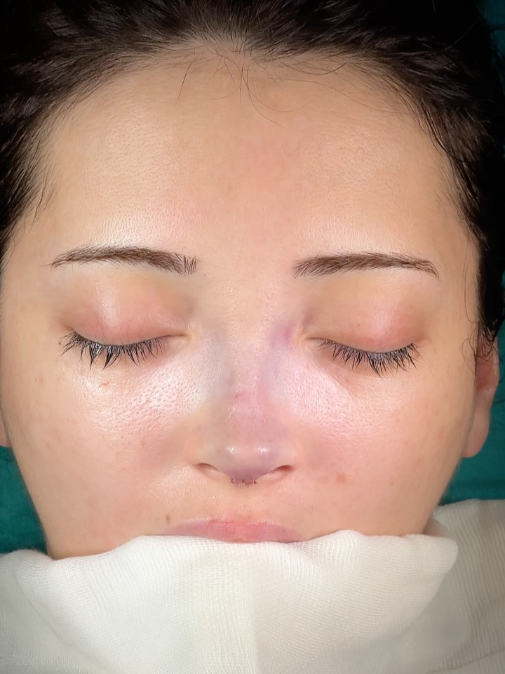 Reduction⭐️
Swipe for the nostril view.