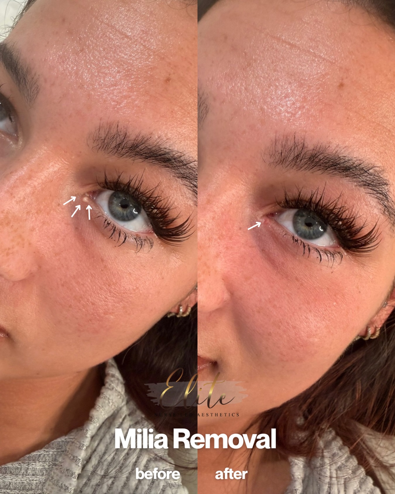 ✨ Milia Removal – Quick, Precise & Confidence Restoring ✨
This lovely client originally visited us for a completely different treatment but mentioned she had been feeling self-conscious about a small lesion under her eye.
Unfortunately, it had previously been misdiagnosed twice as a blocked tear duct and a cyst, and she had been told the only option for removal would be surgical treatment.
After assessment, Nurse Prescriber Katie quickly identified the lesion as a milia — a small keratin-filled cyst that can be safely and easily removed in clinic.
Within just a few minutes, Katie performed a quick, precise and painless removal, with immediate improvement.
Our client was absolutely over the moon with the result and relieved that such a simple treatment could resolve something that had been bothering her for so long.
💬 Sometimes the right diagnosis makes all the difference.
If you have a small bump or lesion around the eyes or face that you’re unsure about, we’re always happy to assess and advise.
#MiliaRemoval #SkinLesions #SkinClinicUK #AdvancedAesthetics #NurseLedAesthetics