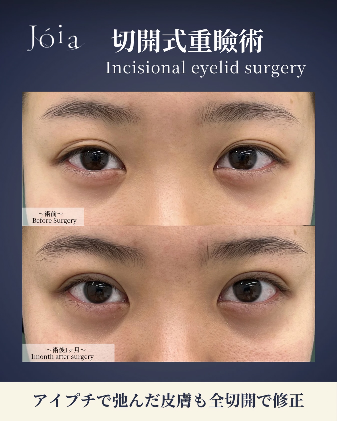 .
.
二重が安定しないことがお悩みの患者様に
全切開式重瞼術を行いました。
【施術名】
全切開式重瞼術
【年代】
20代:女性
【ダウンタイム】
2週間
【副反応・リスク】
皮下出血班、腫脹
Jóia Clinic Kyoto
TEL:075-229-6388
診療時間 10:00~18:00
休診日 日・月・祝
#ジョイアクリニック#二重#切開二重