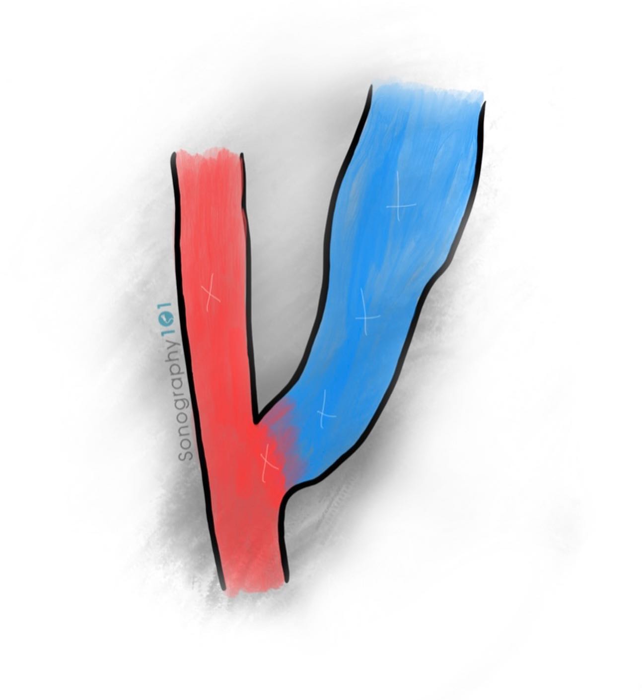 Which type of hemodialysis access do you enjoy scanning more? An AV fistula, straight graft, looped graft, all of the above, or none of the above 😂?