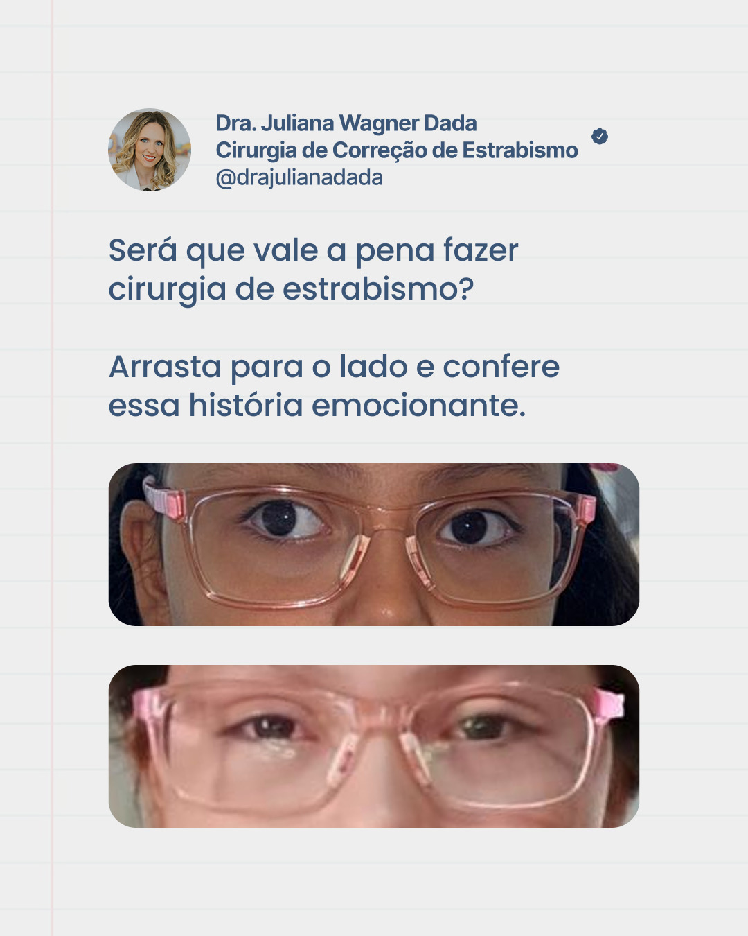 Para muitas crianças, o estrabismo não é só um detalhe.
Ele pode impactar a forma como elas se enxergam, se expressam e se relacionam.
Quando bem indicada, a cirurgia pode trazer mudanças que vão muito além do olhar.
Se você é pai ou mãe e tem essa dúvida, vale procurar avaliação.
Dra. Juliana Wagner Dada
Referência em Estrabismo adulto e infantil
Especialista em Oftalmologia Pediátrica
CRM39665
RQE35215
#estrabismo #saudeocular #oftalmopediatria