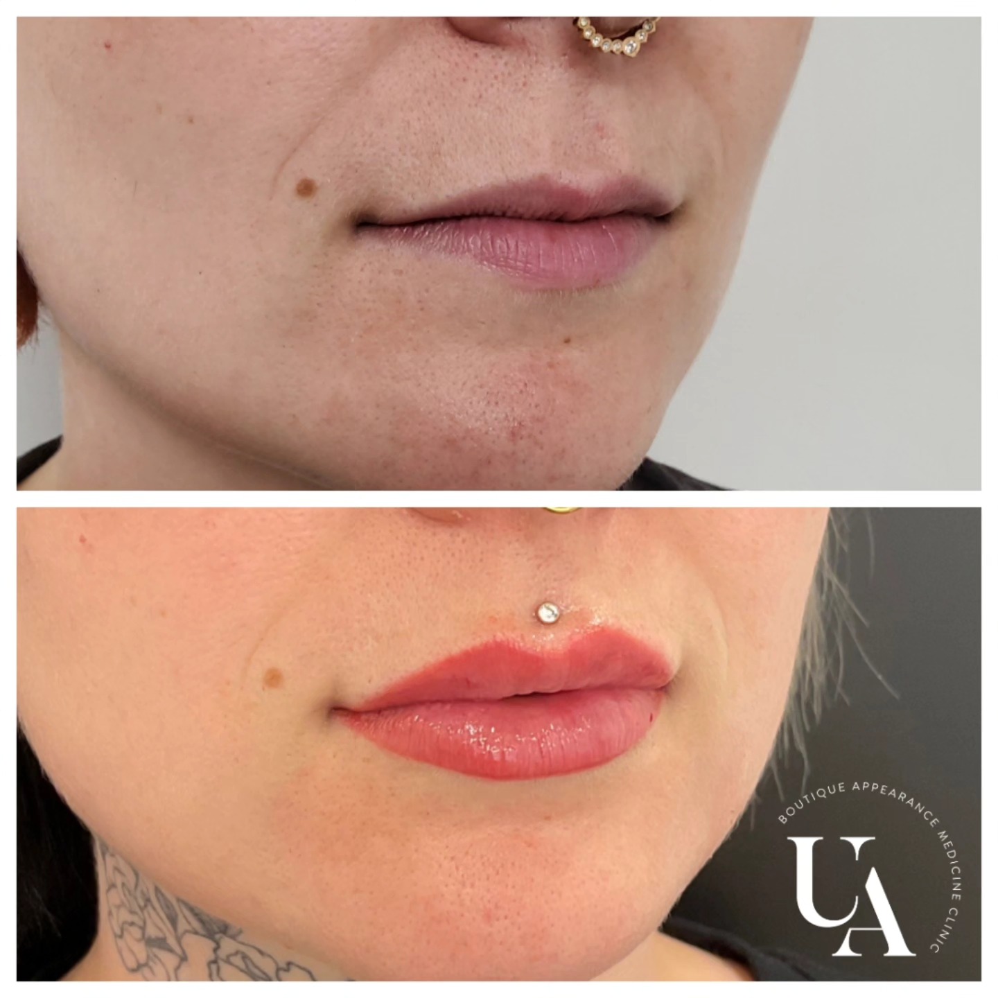 Absolutely in love with these results! 😍
These lips have been gradually built up over the last couple of years.
This lovely lady has also had lip blush in-between sessions. With the wonderful @kayla_ks.beauty_studio
Lip filler and lip blush are such a fantastic combination 🥰
#lipsbyrachel #uniqueaesthetics #lipfillerkapiti #lippies #lipblush #love
Dermal filler injections are Medical devices for the treatment of loss of volume in the skin. Dermal fillers have risks and benefits. Ask your doctor if dermal filler injections are is right for you. For further information ask your doctor or go to www.medsafe.govt.nz