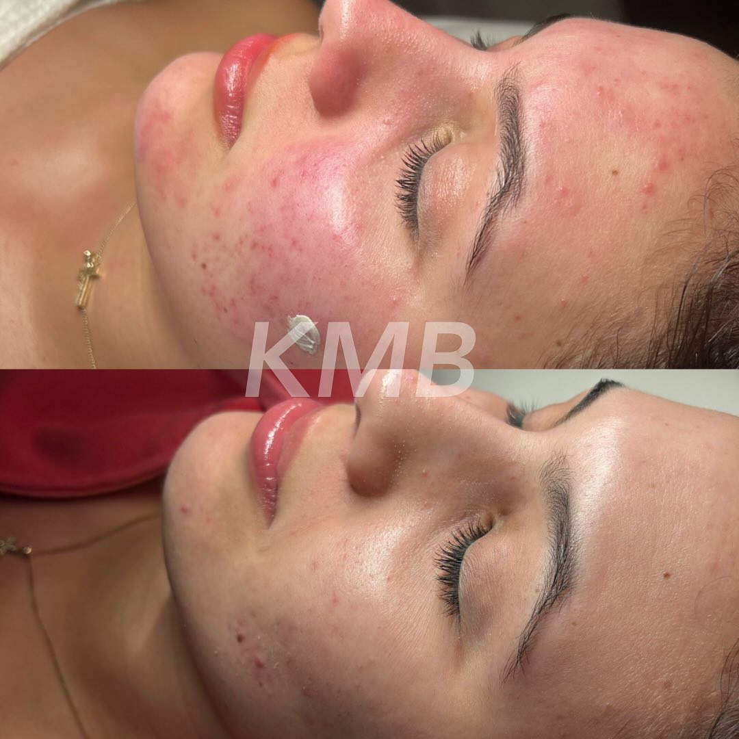 Just a little transformation 🪩… but make it real.
When you start your journey, our relationship STARTS. Consistent communication, support, & trust.
These results are beautiful and I’m so grateful, but reality is, we did have bumps in the road, my client did get discouraged, we did have to change products throughout. But that is what a JOURNEY is. It’s not a consistent uphill, we will go up & down. The goal isn’t perfection, it’s healthy skin 💦.
You are not alone, we will heal your skin 🫶🏼
#skincare #browardfacialist #browardfacials #miamifacialist #miamifacials #browardskincare #browardacneclinic #browardacnespecialist #browardacnefacial #miamiskincare #miamiacnetreatment #miamiacnetreatment #browardestheticians #miamiesthetician