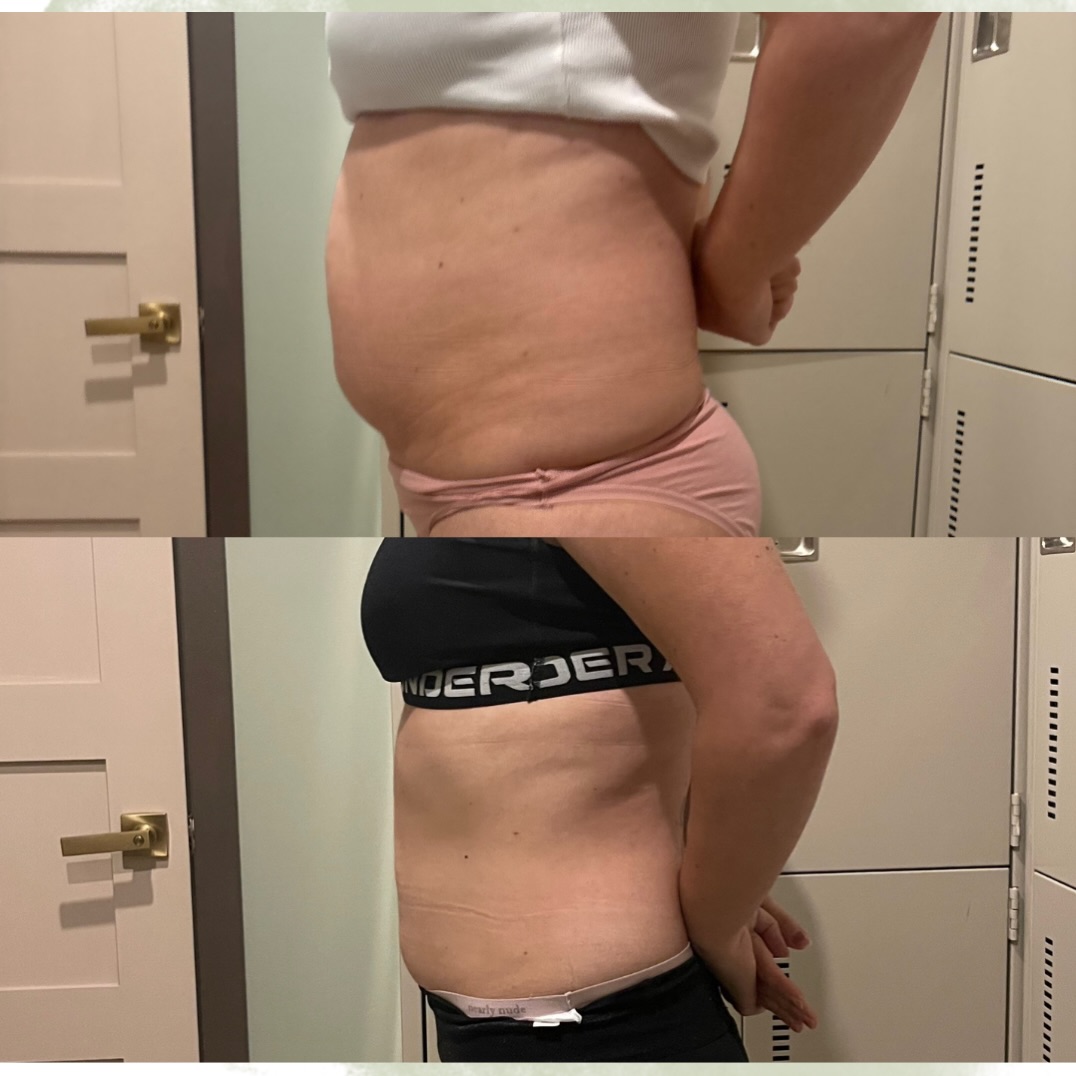 Ultimate body contour with cryoslimming for the win 🙌