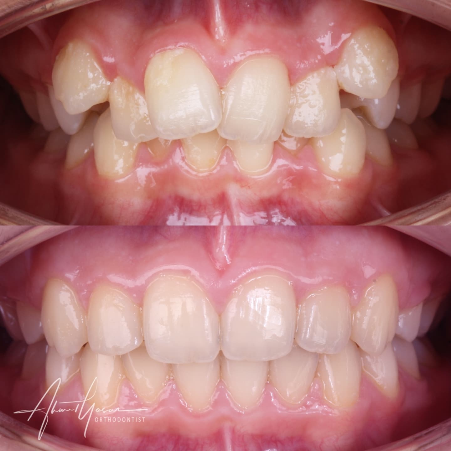 Upper first premolars extraction.
.
Our clinic is authorized by the Ministry of Health of the Republic of Türkiye for International Health Tourism. All patients have been informed and have provided consent for the use of their photographs on our social media platforms. All content shared on social media is intended to inform patients about procedures and should not be perceived as advertising. Outcomes of any surgical or interventional treatment may vary from person to person. It is recommended to consult your physician for detailed information before undergoing any procedure.
.
.
.
#ortodonti #ortodontist #bursa #bursaortodonti #bursaortodontist #bursaortodontiuzmanı #orthodontics #braces #teltedavisi #dişteli #orthognathicsurgery #invisalign #clearcorrect #şeffafplak #lingualortodonti #dişteli #çeneameliyatı #selfligating #kapaklıbraket #gülüştasarımı #dent #dentistry #photography #estetik #dentalart #ahmetyasar #drahmetyasar