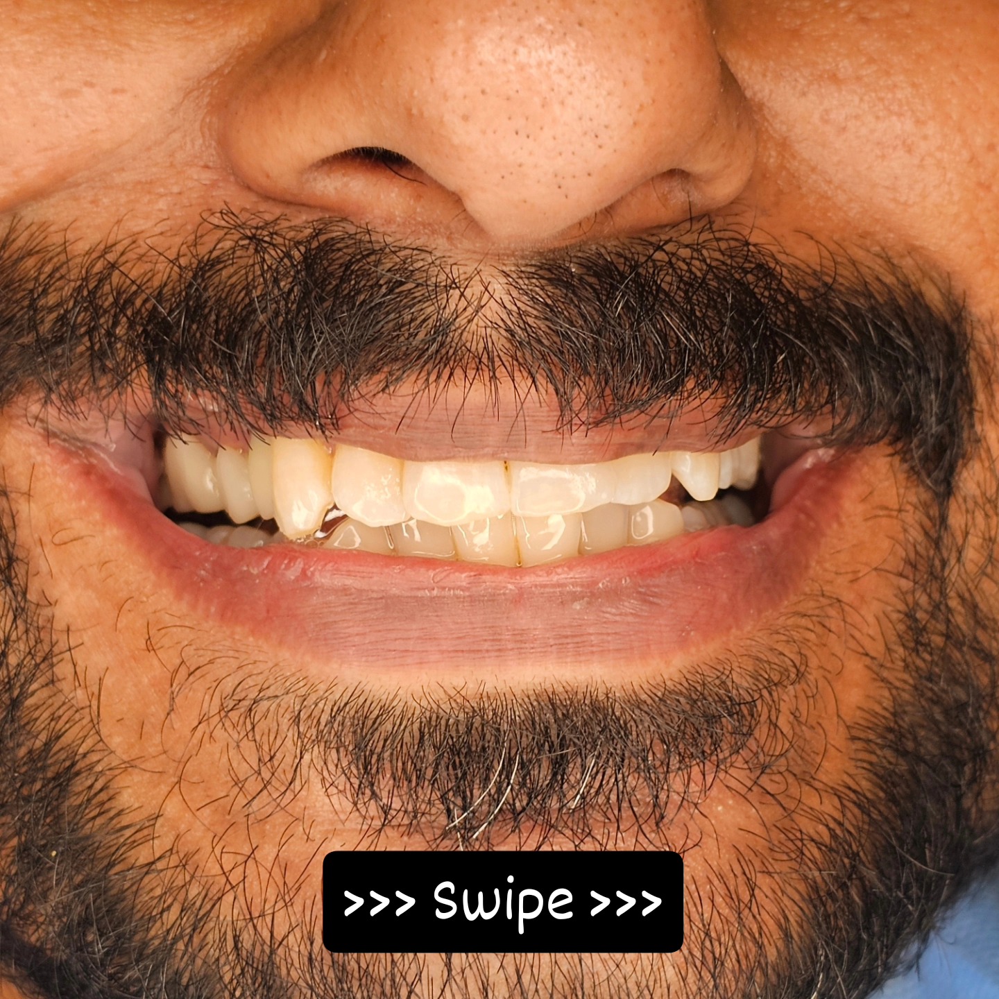 The soft embrace of healthy peri-implant mucosa – where beauty meets function!
Precise Pleasant and Aesthetic Dentistry By Dr. Sethuraman Ramadoss MDS Prosthodontist and Implantologist at Sethu's Dental House
#dentistry #dentalcare #oralhealth #dentalhygiene #smile #teethwhitening #dentalimplants #cosmeticdentistry #healthysmile #toothfairy #dentist #dentistrylife #dentalclinic #oralhygiene #dentallove #smilemakeover #smilegoals #teeth #braces #periodontics #endodontics #dentalfun #dentistryworld #healthygums #dentalcommunity #zirconia #sethusdentalhouse #chennai #chrompet