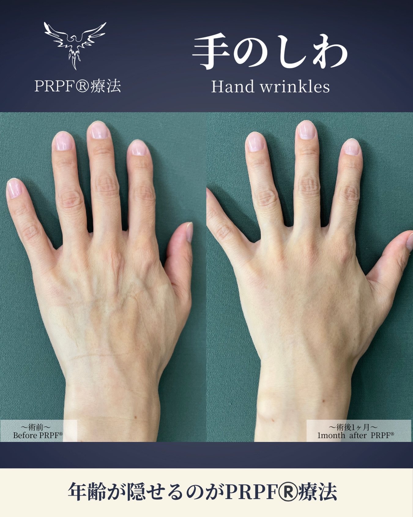 .
.
【施術名】
PRPF療法(6.6cc)
※片手に3.3ccずつ注入
【年代】
30代:女性
【施術費用】
¥660,000(税込)※両手
【ダウンタイム】
約1週間
【副反応・リスク】
皮下出血斑、腫れ、発赤、使用時の軽い痛み
Jóia Clinic Kyoto
TEL:075-229-6388
診療時間 10:00~18:00
休診日 日・月・祝
#ジョイアクリニック#ジョイアクリニック京都#PRPF#PRPF療法