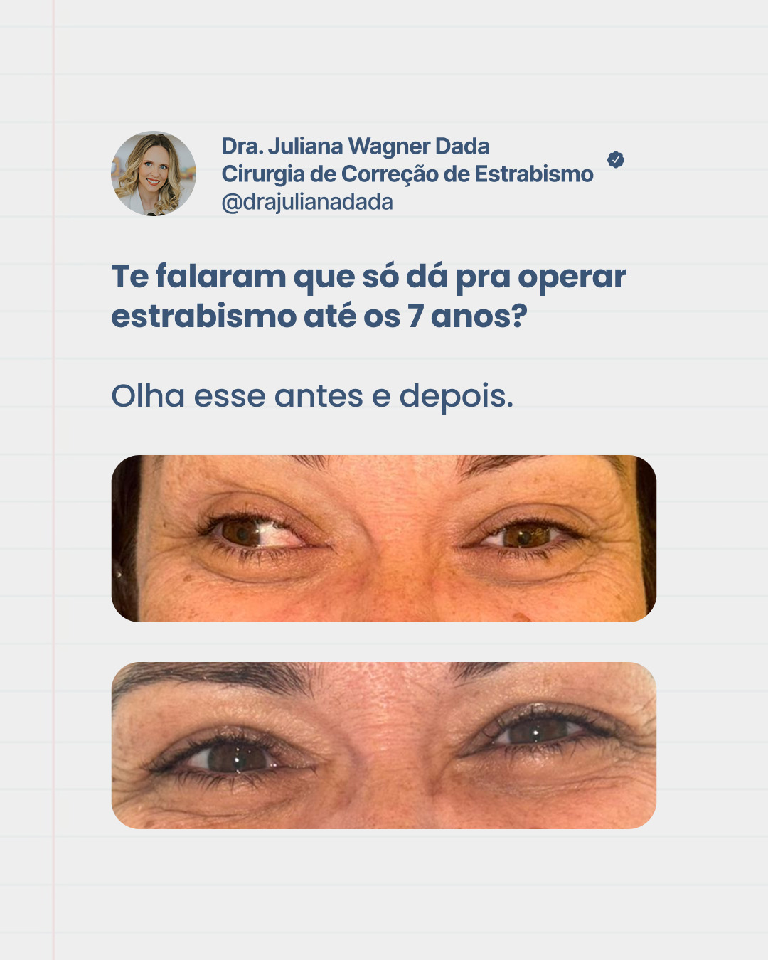 Muita gente ainda acredita que existe idade limite para tratar o estrabismo.
Mas isso não é verdade.
O tratamento pode ser feito em diferentes fases da vida, e vai muito além da estética.
Esse antes e depois mostra mais do que um alinhamento. Mostra uma mudança na forma de se enxergar.
Dra. Juliana Wagner Dada
Referência em Estrabismo adulto e infantil
Especialista em Oftalmologia Pediátrica
CRM39665
RQE35215
#estrabismo #saudeocular #oftalmopediatria