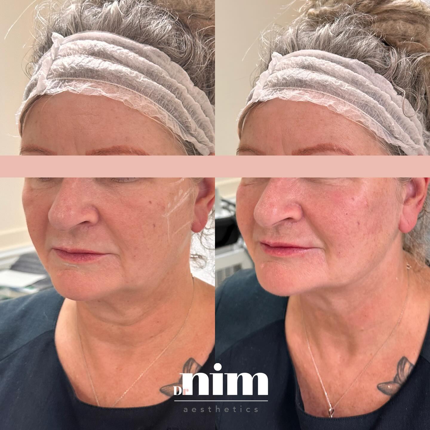 We are loving this natural result for this gorgeous client! 🤩
She recently noticed a few early signs of ageing, particularly around her cheeks and lower face. She didn’t like the ‘heaviness’ around the jawline, also known as the 'jowls' - they act as a distraction along the jaw. Our eye is drawn to them as they stand out.
In the 'after' photo, see how we have lifted the cheeks as well as softened the jowls - the light now bounces off these areas, making her look more refreshed. Her face is harmonised and she looks more youthful.
The less shadows there are, the more light that hits the face and the fresher you look!
Message or email info@DrNim.co.uk for more information 📩
#ageingskin #youthfulskin