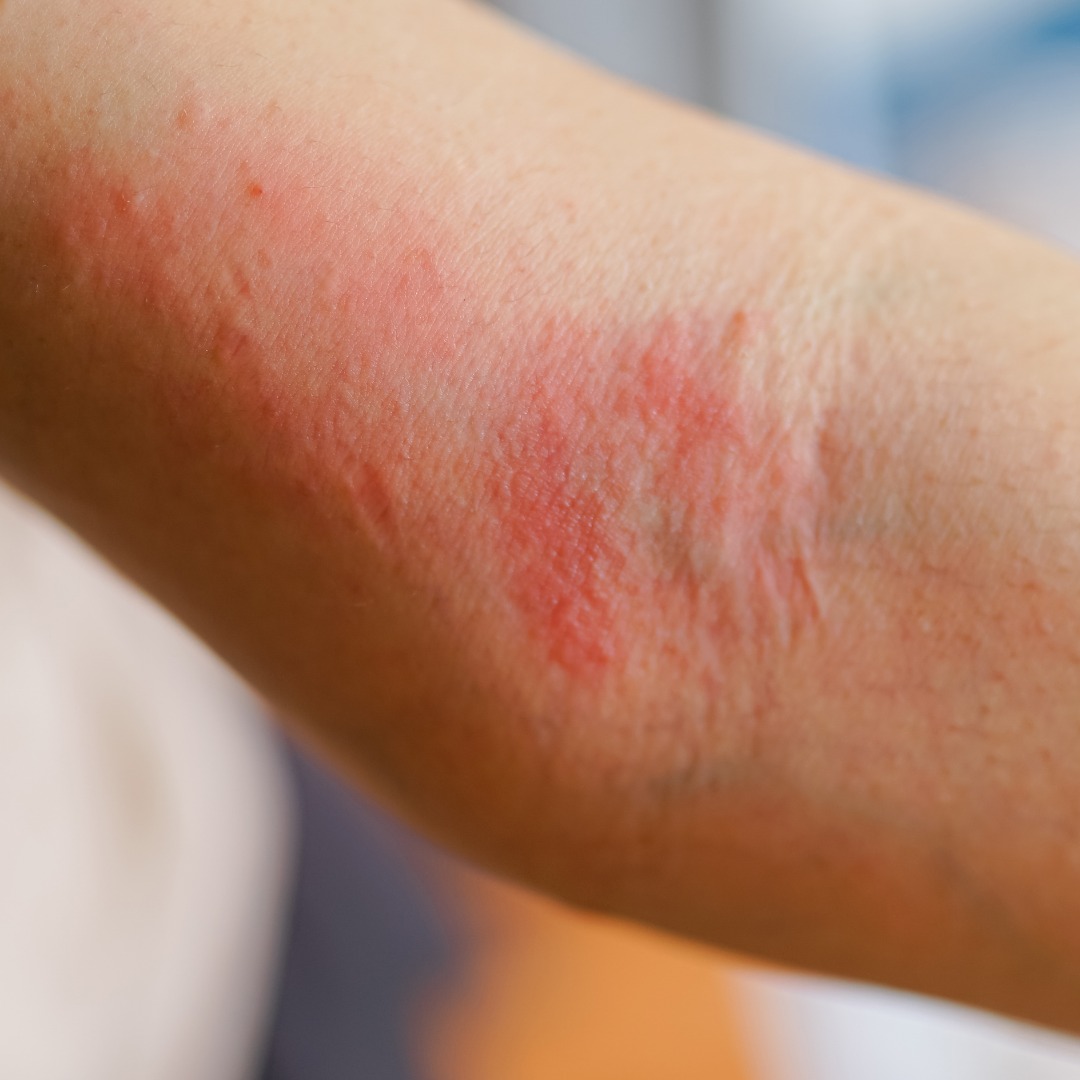 |DERMATOLOGIA|
El pol·len i els al·lergògens ambientals poden afectar la pell, sobretot si és sensible o atòpica.
Pot aparèixer:
Picor
Enrogiment
Dermatitis o urticària
Petits brots d'èczema
💡 Recomanació: netejar bé la pell a la nit i usar cremes calmants amb niacinamida, civada o ceramides.