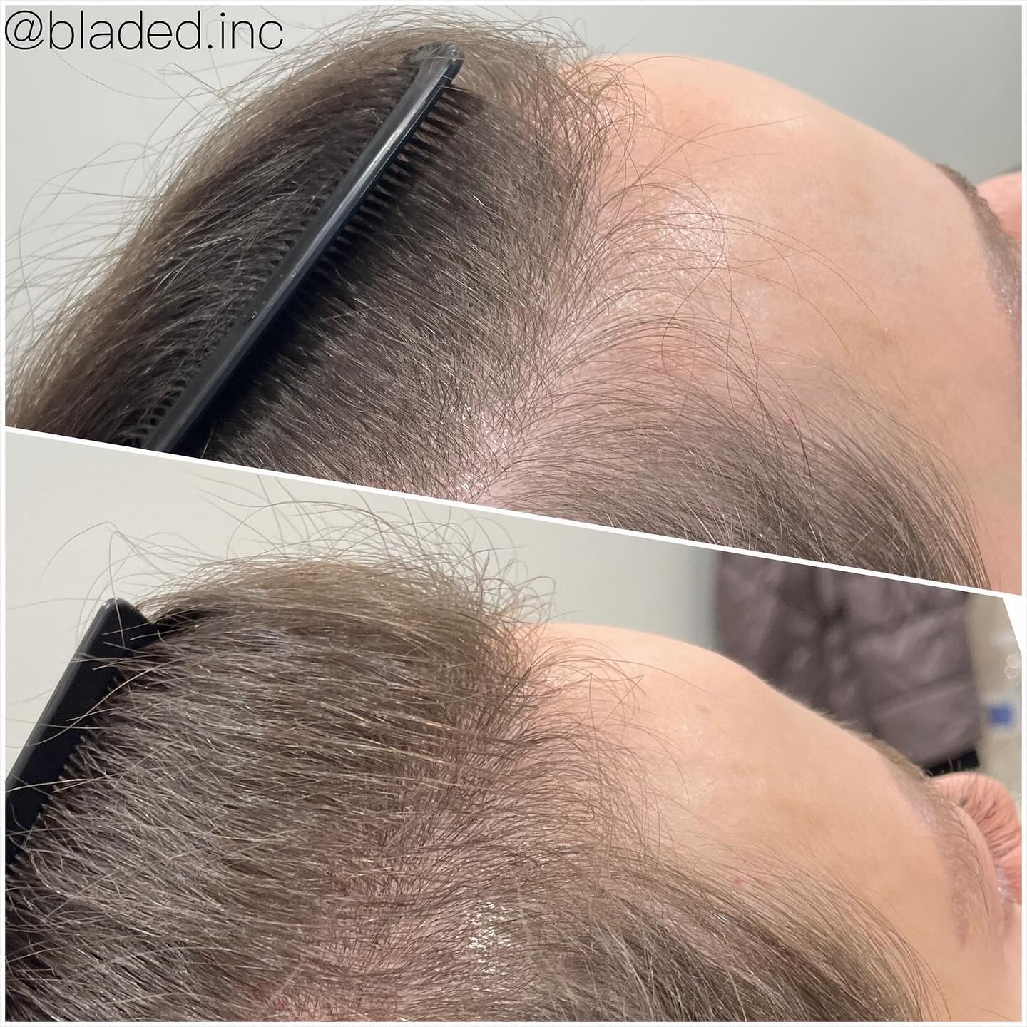 Before vs After 2 TED Hair restoration treatments π€©
Swipe β¬
οΈto see all the little bouncing baby hairs ππ»ββοΈ
#almated #tedhairrestoration #hairrestoration #zionsville #zionsvillemoms #zionsvillehair