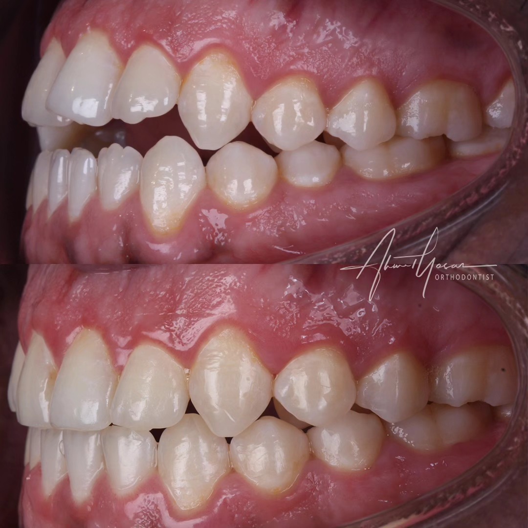 An open bite case.
Ön açık kapanış, ortodontik tedaviler ile düzeltilebilir.
.
Our clinic is authorized by the Ministry of Health of the Republic of Türkiye for International Health Tourism. All patients have been informed and have provided consent for the use of their photographs on our social media platforms. All content shared on social media is intended to inform patients about procedures and should not be perceived as advertising. Outcomes of any surgical or interventional treatment may vary from person to person. It is recommended to consult your physician for detailed information before undergoing any procedure.
.
.
.
#ortodonti #ortodontist #bursa #fsm #bursaortodonti #bursaortodontist #bursaortodontiuzmanı #orthodontics #braces #teltedavisi #invisalign #invisalignbursa #şeffafplak #lingualortodonti #lingualorthodontics #dişteli #ortholove #selfligating #kapaklıbraket #gülüştasarımı #dent #dentistry #art #picoftheday #photography #estetik #dentalart #ahmetyasar #drahmetyasar