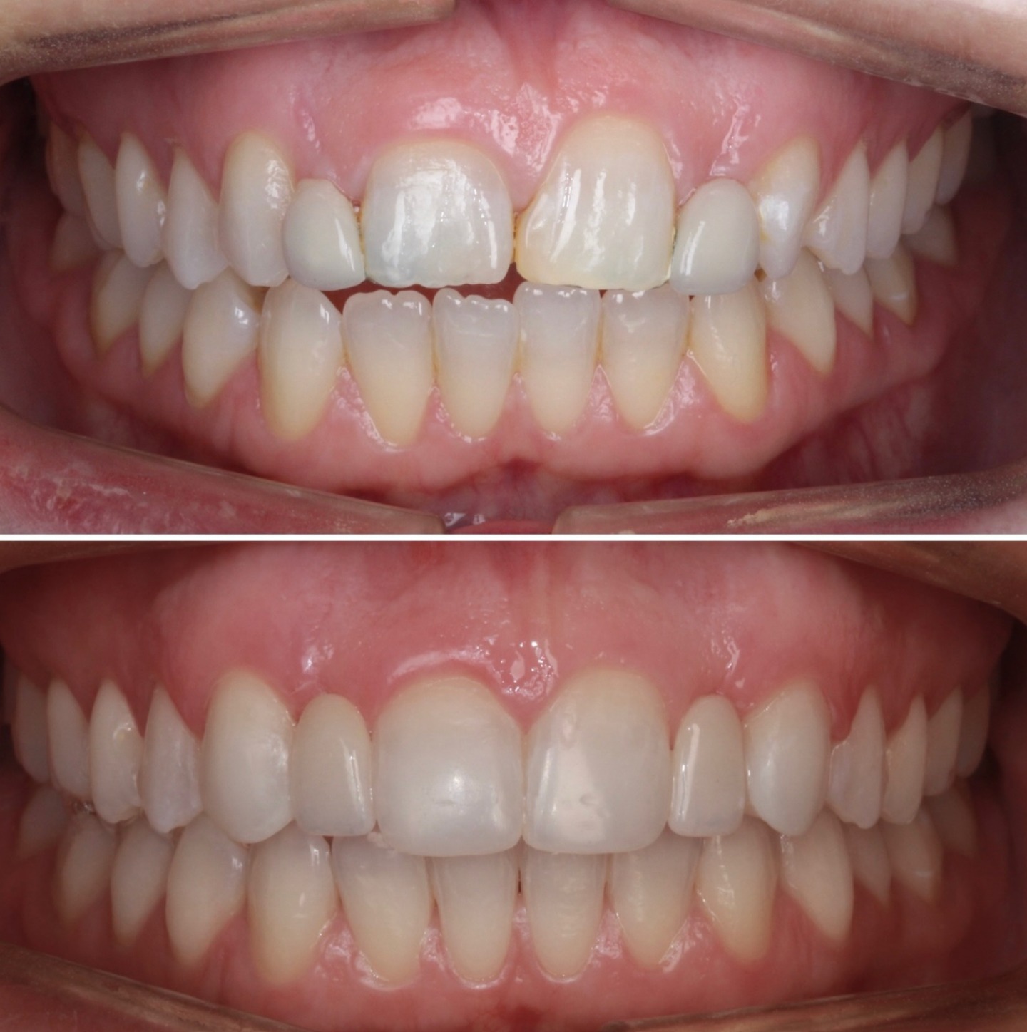 When we look at a smile, it is so more than just teeth. A smile says what words can’t and behind every smile is a person with a story. It was a privilege to treat this wonderful patient and to see her confidence and self-belief blossom as we transformed her smile. This case is one example of what we can achieve with the intense planning and close collaboration that goes into every case we treat.
After world class orthodontic treatment carried out by Dr Emma Laing @dremmalaing, @kavitnshah crafted the smile using a combination of composite bonding followed by the replacement of existing bridgework with new all-ceramic adhesive bridges hand crafted by our master dental technician @richart.ds. The result is beauty as nature intended.💙
Get in touch with our team to book your appointment - we look forward to seeing you soon!
The London Centre For Prosthodontics
29 Weymouth Street
London, W1G 7DB
020 7637 4518
info@londonprosthodontics.com
Monday - Friday: 7:30am - 4:30pm
#SmileMakeover #EmergencyDentistLondon #LondonDentalClinic #SmileTransformation #CosmeticDentistLondon