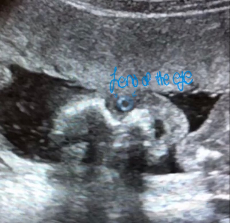 Did you know congenital cataracts can be diagnosed as early as 15 weeks?! 😮
The first two images show normal lenses. however, the third image shows a fetus with cataracts, you can see the lens appears very hyperechoic, in comparison to the other two images.
This is one of the more common ocular anomalies, read more about it on the article images: “Congenital cataracts – Clinical considerations in ultrasound diagnosis and management” 🤓
.
.
.
#ultrasound #sonography #medicalsonography #RDMS #RVT #RegisteredDiagnosticMedicalSonographer #RegisteredVascularTechnologist #UltrasoundTechnologist #Sonographer #UltrasoundTech #Sonography101 #ultrasoundED #ultrasononography #ultrasonographer #Medicine #Medical #Radiology #Radiologia #Ultrasonido #DiagnosticImaging #Medicina #Sonograma
#sonographystudent #sonographyschool