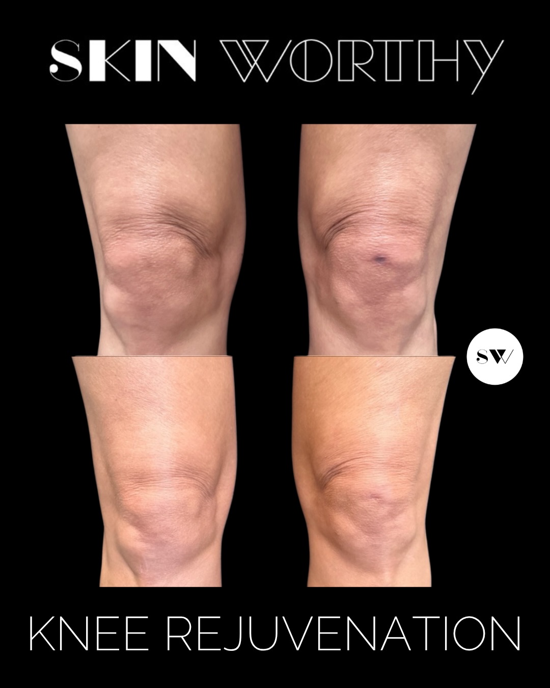 If you’re old enough to remember Demi Moore’s knee lift before Charlies Angels, then it’s something you might be thinking about now…
✨ Non Surgical Knee Rejuvenation ✨
Over time, the skin around the knees can experience a natural decline in collagen and elasticity, affecting overall skin quality.
With a combination of Sculptra to support long-term collagen production and Morpheus8 to enhance skin firmness and texture, this treatment works beneath the surface to gradually rejuvenate the area.
The result is healthier-looking, more resilient skin with a smoother, refreshed appearance 💫
#KneeRejuvenation #Sculptra #Morpheus8 #CollagenSupport SkinTightening